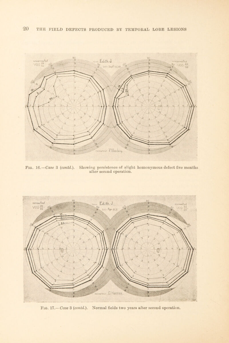 90 90 Uneorrechii/ ,«b VOD un corrected ,c 20 Fig. 16.—Case 3 (contd.). Showing persistence of slight homonymous defect five months after second operation. Fig. 17.—Case 3 (contd.). Normal fields two years after second operation