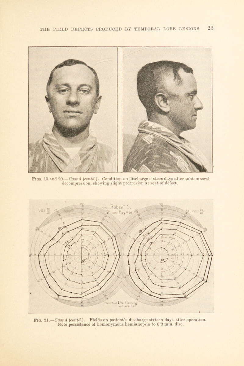 Figs. 19 and 20.—Case 4 (contd.). Condition on discharge sixteen days after subtemporal decompression, showing slight protrusion at seat of defect. Fig. 21. — Case 4 {contd.). Fields on patient’s discharge sixteen days after operation Note persistence of homonymous hemianopsia to 0’3 mm. disc.