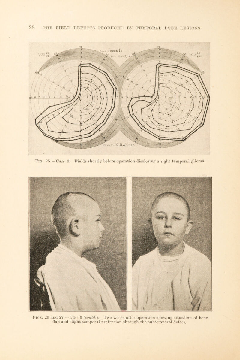 aco Dec 15 Ptrimetnst 09 8 : 7 | ! 1 [ A. 6 5 \ 13 ii . I T Fig. 25.— Case 6. Fields shortly before operation disclosing a right temporal glioma. Figs. 26 and 27.—Ca«e 6 (contd.). Two weeks after operation showing situation of bone flap and slight temporal protrusion through the subtemporal defect.