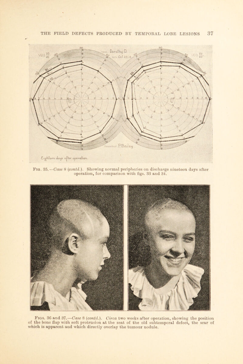 Fig. 35.—Case 8 (contd.). Showing normal peripheries on discharge nineteen days after operation, for comparison with figs. 33 and 34. Figs. 36 and 37.—Case 8 [contd.). Circa two weeks after operation, showing the position of the bone flap with soft protrusion at the seat of the old subtemporal defect, the scar of which is apparent and which directly overlay the tumour nodule.