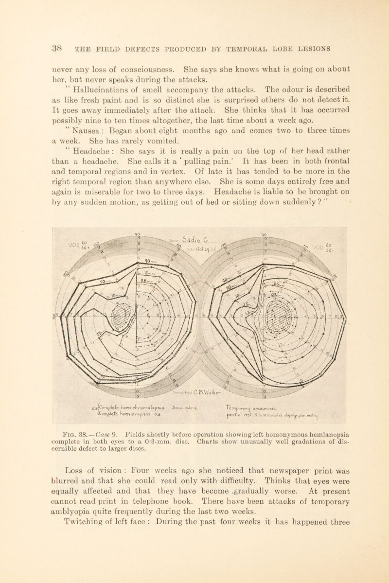 never any loss of consciousness. She says she knows what is going on about her, but never speaks during the attacks. Hallucinations of smell accompany the attacks. The odour is described as like fresh paint and is so distinct she is surprised others do not detect it. It goes away immediately after the attack. She thinks that it has occurred possibly nine to ten times altogether, the last time about a week ago. “Nausea: Began about eight months ago and comes two to three times a week. She has rarely vomited. “ Headache : She says it is really a pain on the top of her head rather than a headache. She calls it a ‘ pulling pain.’ It has been in both frontal and temporal regions and in vertex. Of late it has tended to be more in the right temporal region than anywhere else. She is some days entirely free and again is miserable for two to three days. Headache is liable to be brought on by any sudden motion, as getting out of bed or sitting down suddenly ? ” i Fig. 38. — Case 9. Fields shortly before operation showing left homonymous hemianopsia ■complete in both eyes to a 0’3-mm. disc. Charts show unusually well gradations of dis¬ cernible defect to larger discs. Loss of vision : Four weeks ago she noticed that newspaper print was blurred and that she could read only with difficulty. Thinks that eyes were equally affected and that they have become .gradually worse. At present cannot read print in telephone book. There have been attacks of temporary amblyopia quite frequently during the last two weeks. Twitching of left face : During the past four weeks it has happened three