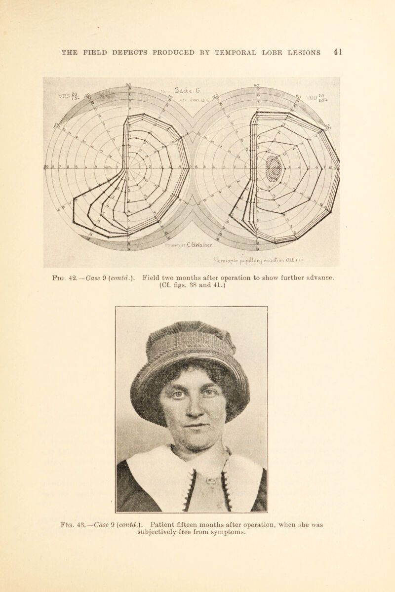 Hemiopi'e pupillurij reaction Q.U. +++• Fig. 42. — Case 9 (cnntd.). Field two months after operation to show further advance (Cf. figs. 38 and 41.) FtG. 43. — Case 9 (contd.). Patient fifteen months after operation, when she was subjectively free from symptoms.