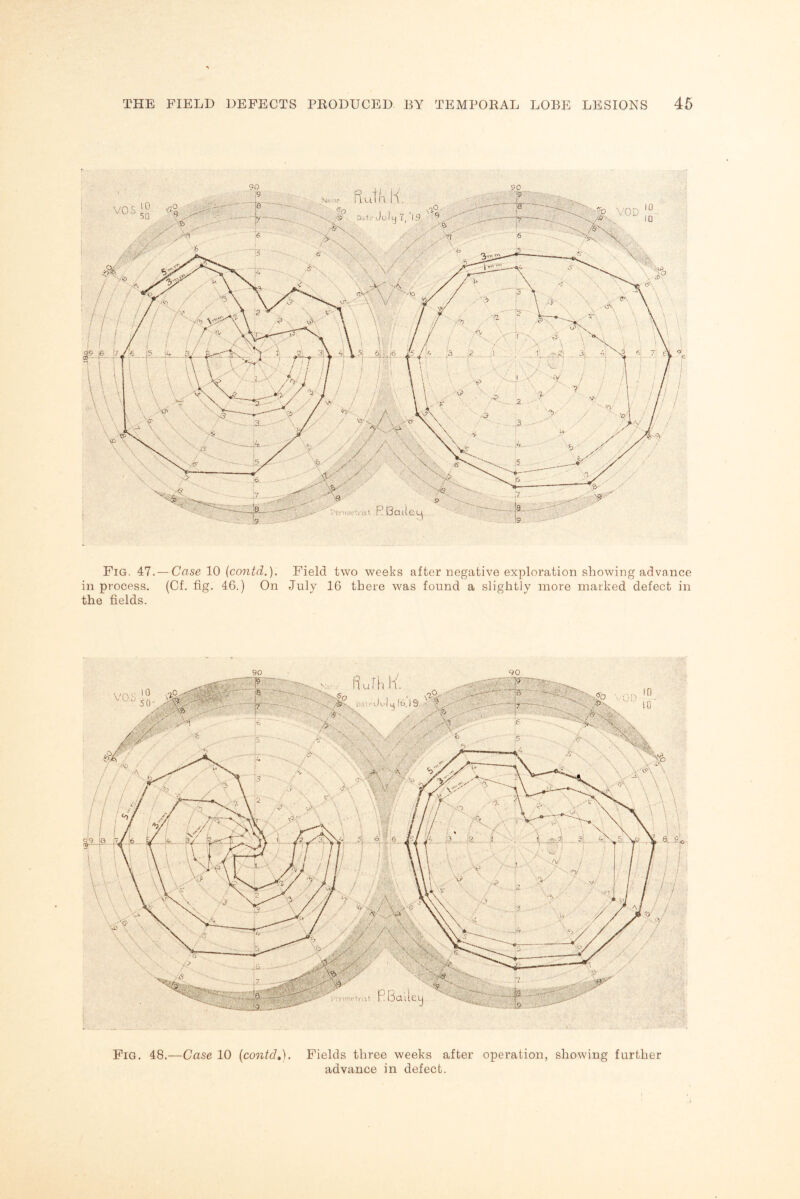 Fig. 48.—Case 10 (contd,). Fields three weeks after operation, showing further advance in defect. VOS VOD Fig. 47.— Case 10 (contd.)- Field two weeks after negative exploration showing advance in process. (Cf. fig. 46.) On July 16 there was found a slightly more marked defect in the fields.