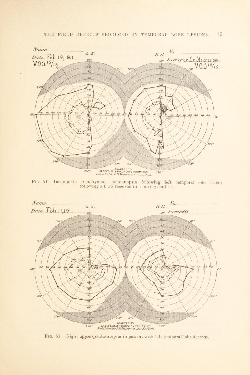 Nas/u± Date..Tj°,b.19 VO. 5. 'Vis rt.K 90° /t'eeon/tx.JD.r_.5l£ptifinSii:n .VO.D.'Ys ADAPTED TO 270° SKEEL'S SELFRECOfiOING PERIMETER. 270° Published bi/E.UMeiyrowitz htr. NewCoi-k. Fig. 51.—Incomplete homonymous hemianopsia following left temporal lobe lesion following a blow received in a boxing contest. Afasrue Dat& Teb lLim. Ao R.K 90o Itecenter m- ADAPTED TO 2700 SKEEL'S SELFRECORDING PERIMETER 2700 T-’u/Wu-AecI byJY.RMei/roHitz, Inc NewYork. Fig, 52.—Right upper quadrantopsia in patient with left temporal lobe abscess.