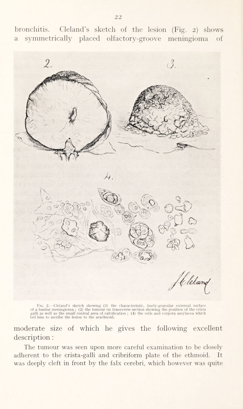 a symmetrically placed olfactory-groove meningioma of Fig. 2.—Cleiand’s sketch showing (3) the characteristic, finely-granular external surface of a basilar meningioma ; (2) the tumour on transverse section showing the position of the crista galli as well as the small central area of calcification ; (4) the cells and corpora amylacea which led him to ascribe the lesion to the arachnoid. moderate size of which he gives the following excellent description: The tumour was seen upon more careful examination to be closely adherent to the crista-galli and cribriform plate of the ethmoid. It was deeply cleft in front by the falx cerebri, which however was quite