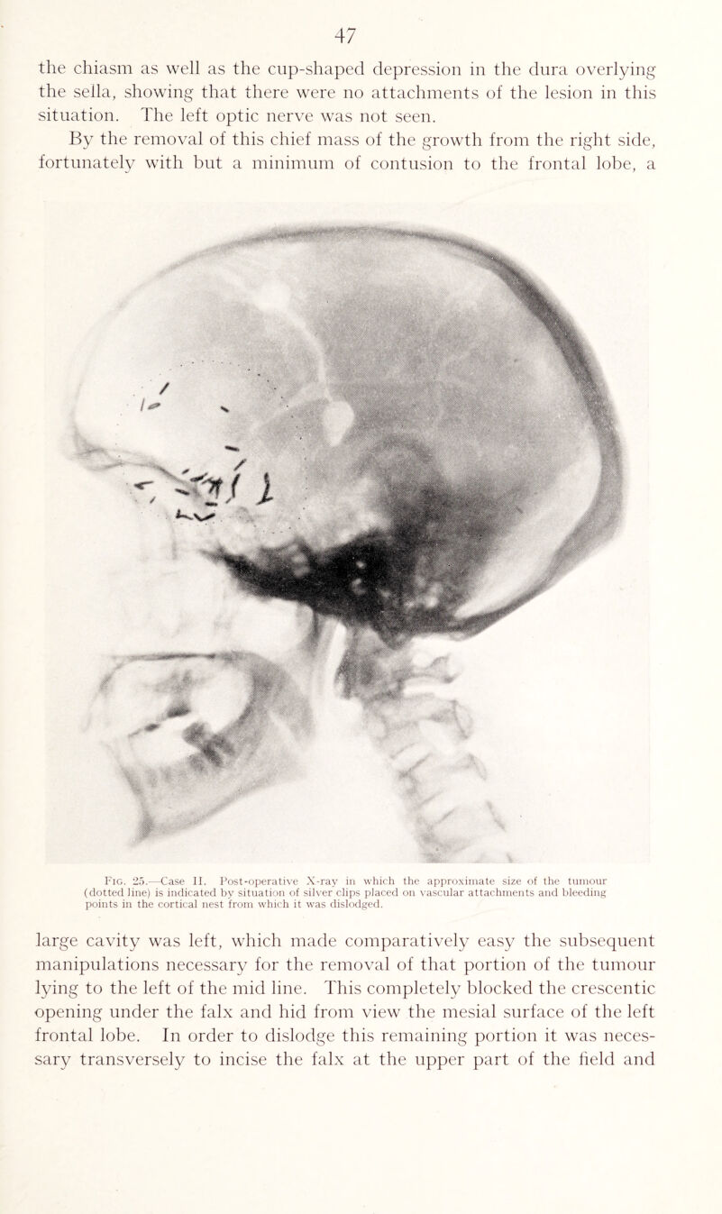 the chiasm as well as the cup-shaped depression in the dura overlying the sella, showing that there were no attachments of the lesion in this situation. The left optic nerve was not seen. By the removal of this chief mass of the growth from the right side, fortunately with but a minimum of contusion to the frontal lobe, a Fig. 25.—Case II. Post-operative X-ray in which the approximate size of the tumour (dotted line) is indicated by situation of silver clips placed on vascular attachments and bleeding points in the cortical nest from which it was dislodged. large cavity was left, which made comparatively easy the subsequent manipulations necessary for the removal of that portion of the tumour lying to the left of the mid line. This completely blocked the crescentic opening under the falx and hid from view the mesial surface of the left frontal lobe. In order to dislodge this remaining portion it was neces¬ sary transversely to incise the falx at the upper part of the held and