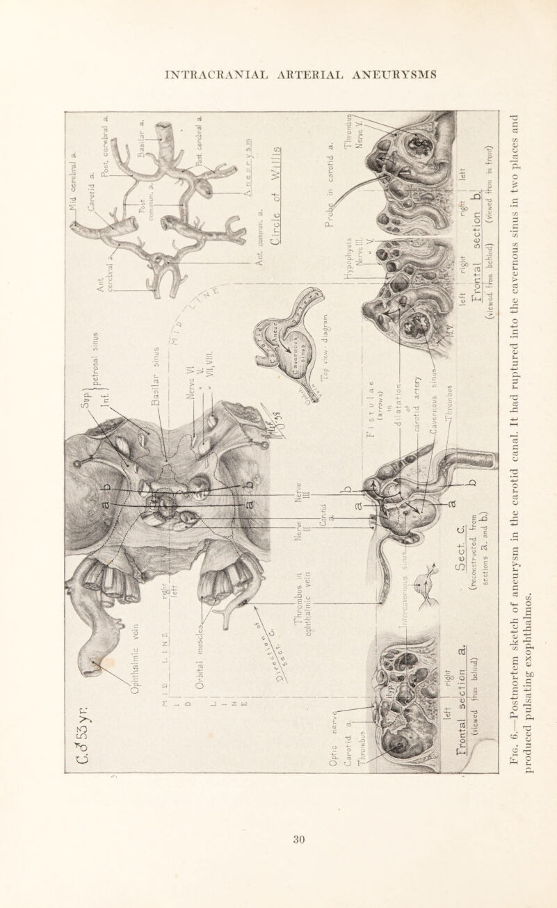 IN TR AC R AN IAI VRTERIAI ANEURYSMS Fig. 6.—Postmortem sketch of aneurysm in the carotid canal. It had ruptured into the cavernous sinus in two places and produced pulsating exophthalmos.