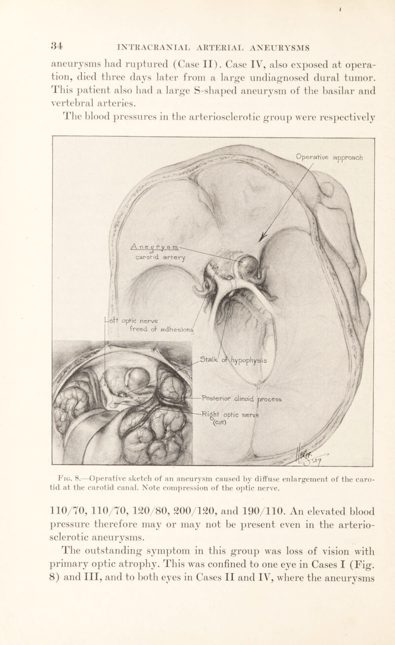 ( 34 INTRACRANIAL ARTERIAL ANEURYSMS aneurysms had ruptured (Case II). Case IV, also exposed at opera¬ tion, died three days later from a large undiagnosed dural tumor. This patient also had a large S-shaped aneurysm of the basilar and vertebral arteries. The blood pressures in the arteriosclerotic group were respectively Fig. 8.—Operative sketch of an aneurysm caused by diffuse enlargement of the caro¬ tid at the carotid canal. Note compression of the optic nerve. 110/70, 110/70, 120/80, 200/120, and 190/110. An elevated blood pressure therefore may or may not be present even in the arterio¬ sclerotic aneurysms. The outstanding symptom in this group was loss of vision with primary optic atrophy. This was confined to one eye in Cases I (Fig.
