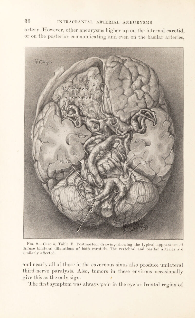 artery. However, other aneurysms higher up on the internal carotid, or on the posterior communicating and even on the basilar arteries, Fig. 9.- Case 5, Table B. Postmortem drawing showing the typical appearance of diffuse bilateral dilatations of both carotids. The vertebral and basilar arteries are similarly affected. and nearly all of those in the cavernous sinus also produce unilateral third-nerve paralysis. Also, tumors in these environs occasionally give this as the only sign. / The first symptom was always pain in the eye or frontal region of