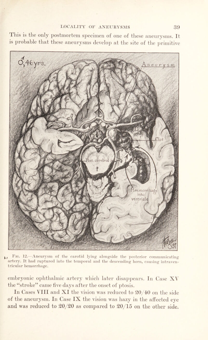 This is the only postmortem specimen of one of these aneurysms. It is probable that these aneurysms develop at the site of the primitive 3ost. cerebral rtaemcrrr into | ventricle m mmgm ■ fU t I1 ig. 12.—Aneurysm of tlie carotid lying alongside the posterior communicating artery. It had ruptured into the temporal and the descending horn, causing intraven¬ tricular hemorrhage. embryonic ophthalmic artery which later disappears. In Case XV the “stroke” came five days after the onset of ptosis. In Cases VIII and XI the vision was reduced to 20/40 on the side of the aneurysm. In Case IX the vision was hazy in the affected eye and was reduced to 20/20 as compared to 20/15 on the other side.