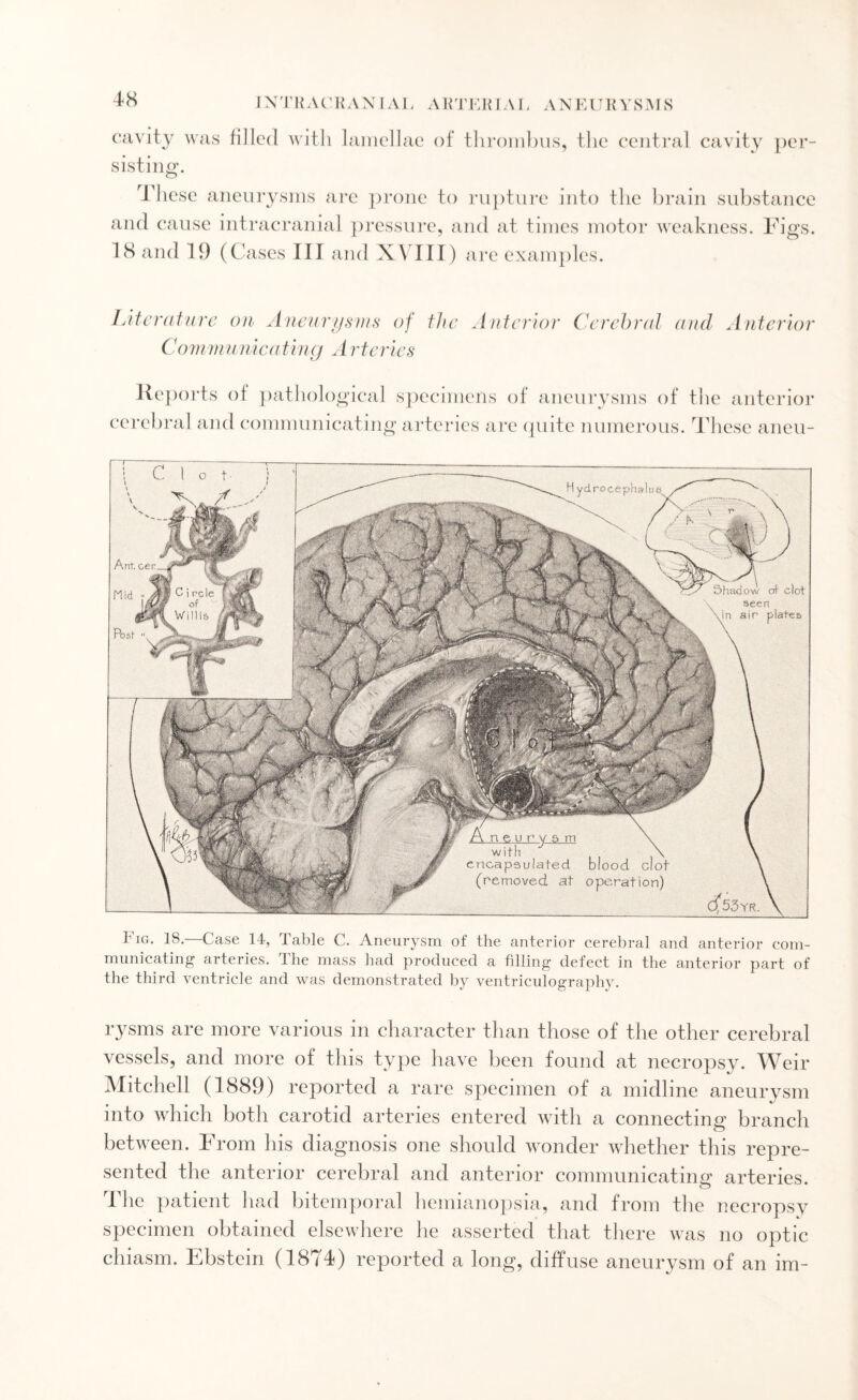 IX T K A CRANIA L AH T E K IAI. A N E U K Y SMS cavity was filled with lamellae of thrombus, the central cavity per¬ sisting. These aneurysms are prone to rupture into the brain substance and cause intracranial pressure, and at times motor weakness. Figs. 18 and 19 (Cases III and XVIII) are examples. Literature on Aneurysms of the Anterior Cerebral and Anterior Communicating A rtcries Reports of pathological cerebral and communicating1 O specimens of aneurysms of the anterior arteries are quite numerous. These aneu- I *g. 18. Case 14, Table C. Aneurysm of the anterior cerebral and anterior com¬ municating arteries. The mass had produced a filling defect in the anterior part of the third ventricle and was demonstrated by ventriculography. rysms are more various in character than those of the other cerebral vessels, and more of this type have been found at necropsy. Weir Mitchell (1889) reported a rare specimen of a midline aneurysm into which both carotid arteries entered with a connecting branch between. From his diagnosis one should wonder whether this repre¬ sented the anterior cerebral and anterior communicating arteries. The patient had bitemporal hemianopsia, and from the necropsy specimen obtained elsewhere he asserted that there was no optic chiasm. Ebstein (1874) reported a long, diffuse aneurysm of an im-