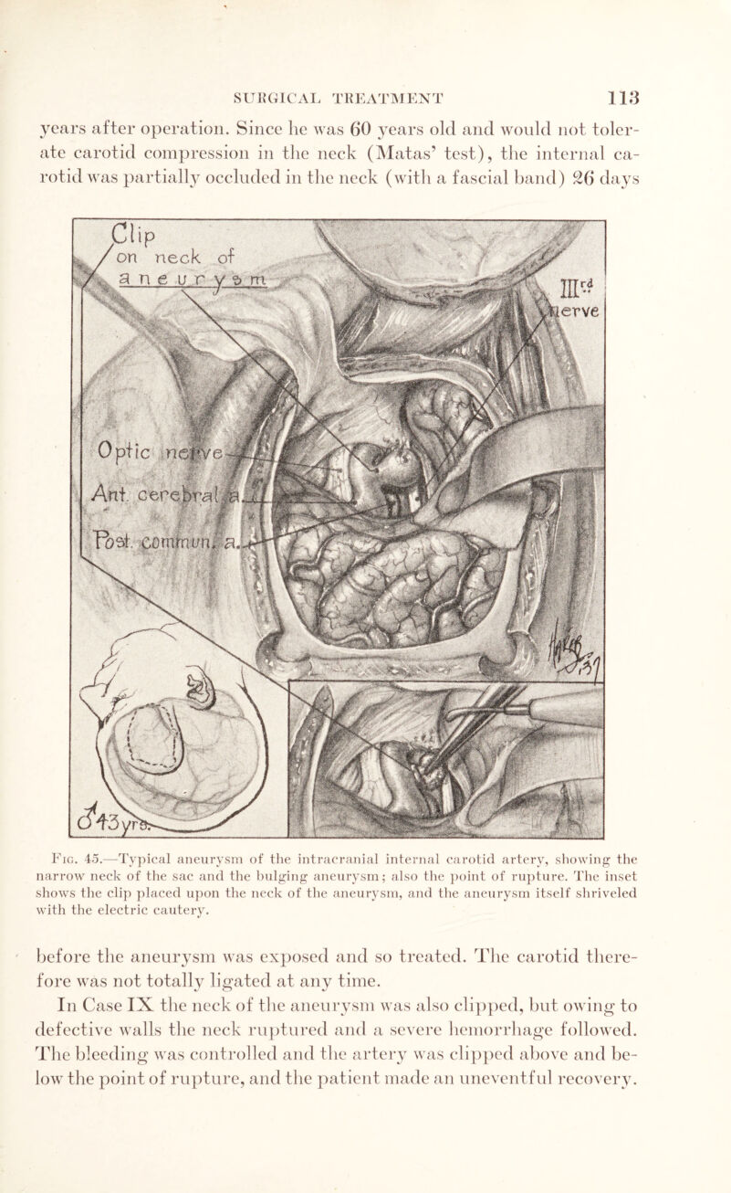 years after operation. Since he was 60 years old and would not toler¬ ate carotid compression in the neck (Matas’ test), the internal ca¬ rotid was partially occluded in the neck (with a fascial band) 26 days Fig. 45.—-Typical aneurysm of the intracranial internal carotid artery, showing the narrow neck of the sac and the bulging aneurysm; also the point of rupture. The inset shows the clip placed upon the neck of the aneurysm, and the aneurysm itself shriveled with the electric cautery. - erve -.- before the aneurysm was exposed and so treated. The carotid there¬ fore was not totally ligated at any time. In Case IX the neck of the aneurysm was also clipped, but owing to defective walls the neck ruptured and a severe hemorrhage followed. The bleeding was controlled and the artery was clipped above and be¬ low the point of rupture, and the patient made an uneventful recovery.