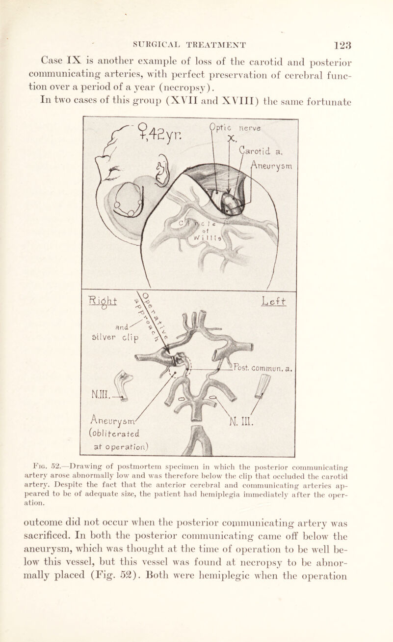 Case IX is another example of loss of the carotid and posterior communicating arteries, with perfect preservation of cerebral func¬ tion over a period of a year (necropsy). In two cases of this group (XVII and XVIII) the same fortunate Big. 52.—Drawing of postmortem specimen in which the posterior communicating artery arose abnormally low and was therefore below the clip that occluded the carotid artery. Despite the fact that the anterior cerebral and communicating arteries ap¬ peared to be of adequate size, the patient had hemiplegia immediately after the oper¬ ation. outcome did not occur when the posterior communicating artery was sacrificed. In both the posterior communicating came off below the aneurysm, which was thought at the time of operation to be well be¬ low this vessel, but this vessel was found at necropsy to be abnor¬ mally placed (Fig. 52). Both were hemiplegic when the operation