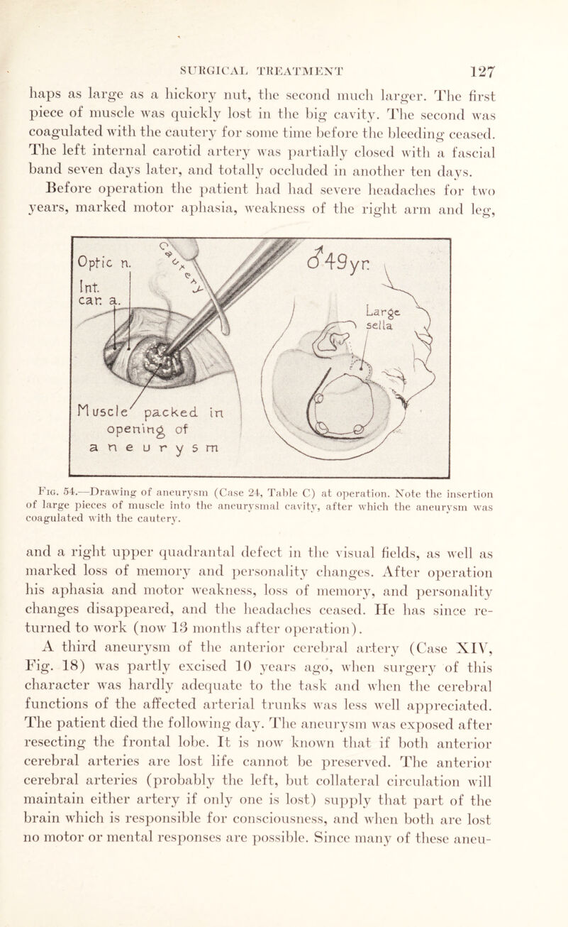 haps as large as a hickory nut, the second much larger. The first piece of muscle was quickly lost in the big cavity. The second was coagulated with the cautery for some time before the bleeding ceased. The left internal carotid artery was partially closed with a fascial band seven days later, and totally occluded in another ten days. Before operation the patient had had severe headaches for two years, marked motor aphasia, weakness of the right arm and leg, Fig. 54.—Drawing of aneurysm (Case 24, Table C) at operation. Note the insertion of large pieces of muscle into the aneurysmal cavity, after which the aneurysm was coagulated with the cautery. and a right upper quadrantal defect in the visual fields, as well as marked loss of memory and personality changes. After operation his aphasia and motor weakness, loss of memory, and personality changes disappeared, and the headaches ceased. He has since re¬ turned to work (now 13 months after operation). A third aneurysm of the anterior cerebral artery (Case XIV, Fig. 18) was partly excised 10 years ago, when surgery of this character was hardly adequate to the task and when the cerebral functions of the affected arterial trunks was less well appreciated. The patient died the following day. The aneurysm was exposed after resecting the frontal lobe. It is now known that if both anterior cerebral arteries are lost life cannot be preserved. The anterior cerebral arteries (probably the left, but collateral circulation will maintain either artery if only one is lost) supply that part of the brain which is responsible for consciousness, and when both are lost no motor or mental responses are possible. Since many of these aneu-