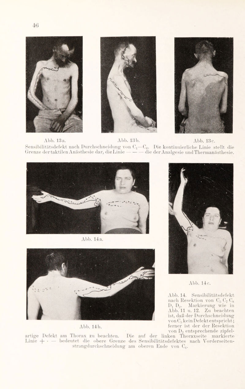 Abb. 13 a. Abb. 13 b. Abb. 13 c. Sensibilitätsdefekt nach Durchschneidung von C4—C6. Die kontinuierliche Linie stellt die Grenze der taktilen Anästhesie dar, die Linie-die der Analgesie undThermanästhesie. Abb. 14 a. Abb. 14 c. Abb. 14. Sensibilitätsdefekt nach Resektion von C5 C7 C8 Dl D2. Markierung wie in Abb. 11 u. 12. Zu beachten ist, daß der Durchschneidung von C5 kein Defekt entspricht; Abb. 14b. ferner ist der der Resektion von D2 entsprechende zipfel- artige Defekt am Thorax zu beachten. Die auf der linken Thoraxseite markierte Linie + • bedeutet die obere Grenze des Sensibilitätsdefektes nach Vorderseiten- strangdurchschneidung am oberen Ende von C6.