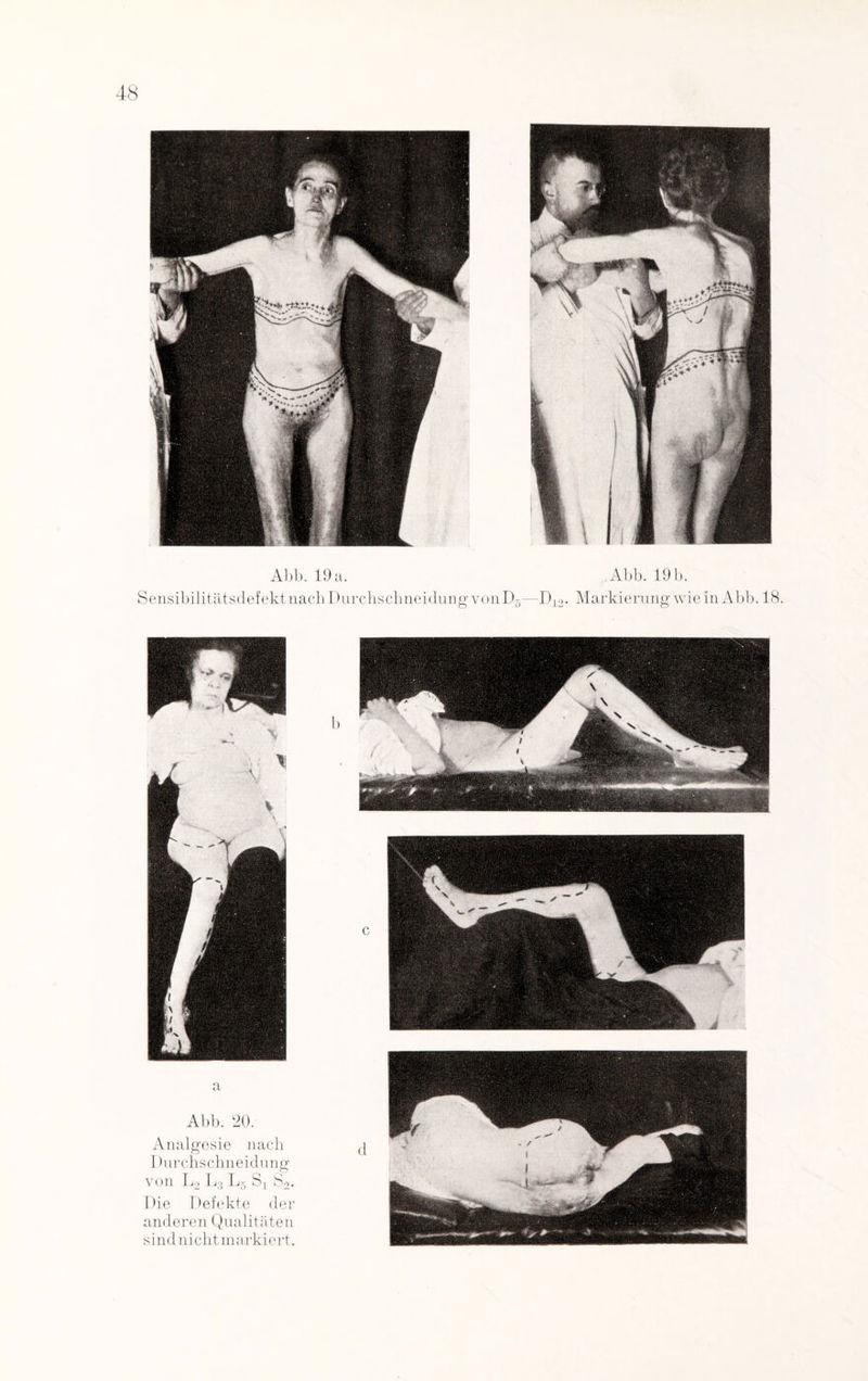 Abb. 19 a. Abb. 19 b. Sensibilitätsdefekt nach I lurchschneidung vonD5—D12. Markierung wie in Abb. 18 a Abb. 20. Analgesie nach j Durchschneidung von L2 L3 L5 Sl S2. Die Defekte d er anderen Qualitäten sind nicht markiert.