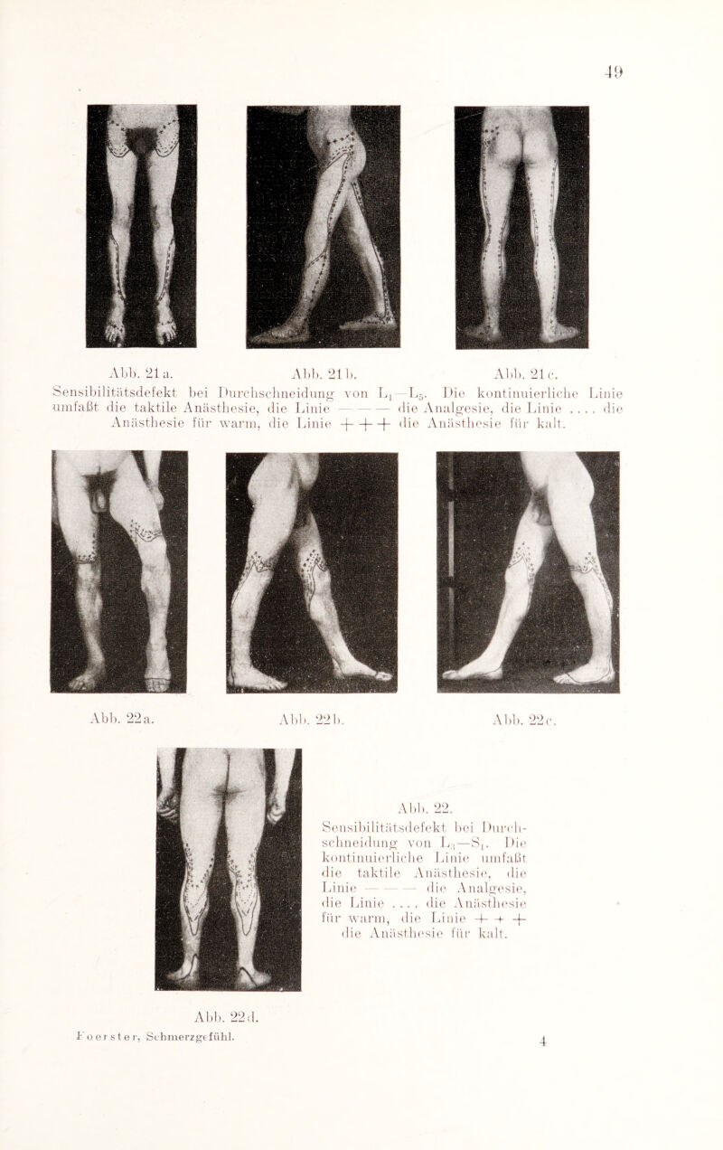 Abb. 21 u. Abb. 21b. Abb. 21c. Sensibilitätsdefekt bei Purchschneidung von Lr L5. Pie kontinuierliche Linie umfaßt die taktile Anästhesie, die Linie-die Analgesie, die Linie .... die Anästhesie für warm, die Linie -j—|—|- die Anästhesie für kalt. Abb. 22 a. Abb. 221). Abb. 22 c. Abb. 22. Sensibilitätsdefekt bei Purch¬ schneidung von Lj—St. Pie kontinuierliche Linie umfaßt die taktile Anästhesie, die Linie- die Analgesie, die Linie .... die Anästhesie für warm, die Linie d—r ~L die Anästhesie für kalt. Abb. 22 d. io erster, Schmerzgefühl. 4