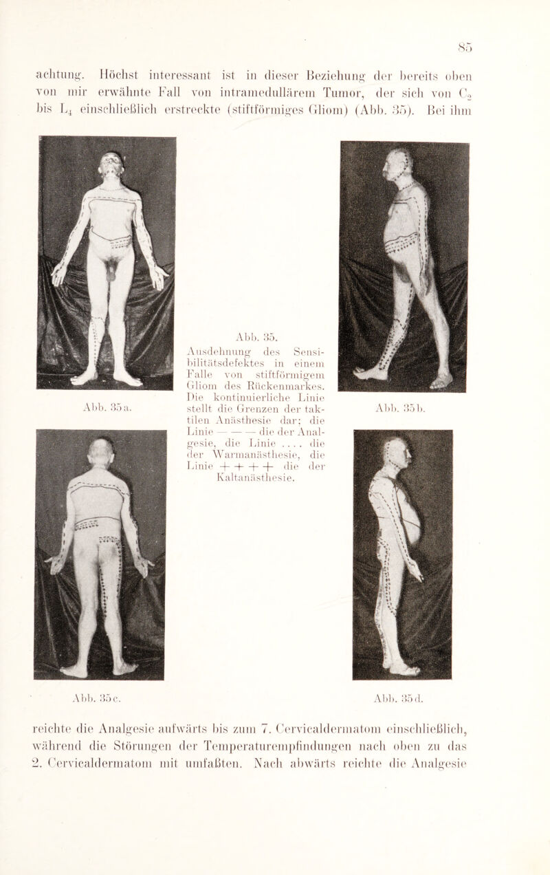 achtung. Höchst interessant ist in dieser Beziehung der bereits oben von mir erwähnte Fall von intramedullärem Tumor, der sich von C2 bis L4 einschließlich erstreckte (stiftförmiges Gliom) (Abb. 35). Bei ihm Abb. 35. Ausdehnung des Sensi¬ bilitätsdefektes in einem Falle von stiftförmigem Gliom des Rückenmarkes. Pie kontinuierliche Linie Abb. 35a. stellt die Grenzen der tak¬ tilen Anästhesie dar; die Linie-die der Anal¬ gesie, die Linie .... die der Warmanästhesie, die Linie -\—|—|—|- die der Kaltanästhesie. Abb. 35 b. Abb. 35 c. Abb. 35 d. reichte die Analgesie aufwärts bis zum 7. Cervicaldermatom einschließlich, während die Störungen der Temperaturempfindungen nach oben zu das 2. Cervicaldermatom mit umfaßten. Nach abwärts reichte die Analgesie