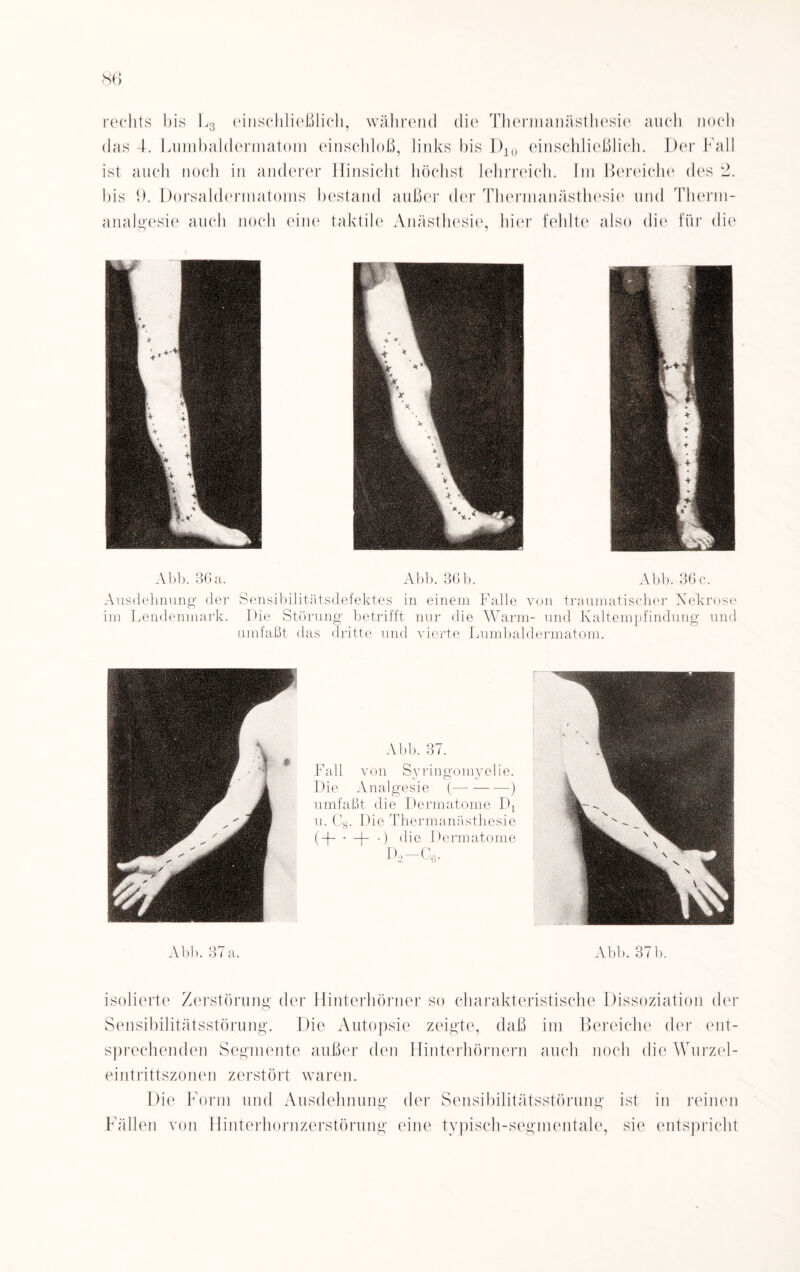 rechts bis h3 einschließlich, während die Thermanästhesie auch noch das T. Lumbaldermatom einschloß, links bis D10 einschließlich. Der Fall ist auch noch in anderer Hinsicht höchst lehrreich. Im Bereiche des 2. bis 9. Dorsaldermatoms bestand außer der Thermanästhesie und Therm- analgesie auch noch eine taktile Anästhesie, hier fehlte also die für die Abb. 36 a. Abb. 36 b. Abb. 36 c. Ausdehnung der Sensibilitätsdefektes in einem Falle von traumatischer Nekrose im Lendenmark. Hie Störung betrifft nur die Warm- und Kaltempfindung und umfaßt das dritte und vierte Lumbaldermatom. Abb. 37. Fall von Syringomyelie. Die Analgesie (-—) umfaßt die Dermatome J)L u. C8. Die Thermanästhesie (-(- • -p •) die Dermatome d2-c6. Abb. 37 a. Abb. 37b. isolierte Zerstörung der Hinterhörner so charakteristische Dissoziation der Sensibilitätsstörung. Die Autopsie zeigte, daß im Bereiche der ent¬ sprechenden Segmente außer den Hinterhörnern auch noch die Wurzel¬ eintrittszonen zerstört waren. Die Form und Ausdehnung der Sensibilitätsstörung ist in reinen Fällen von Hinterhornzerstörung eine typisch-segmentale, sie entspricht