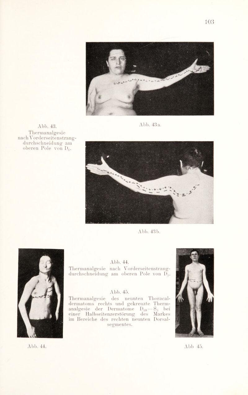 Abb. 43. Thermanalgesie nach Vorderseitenstrang - durchschneidung am oberen Pole von D6. Abb. 43 a. Abb. 431). Abb. 44. Thermanalgesie nach Vorderseitenstrang- durchschneidnng am oberen Pole von D5. Abb. 45. Thermanalgesie des neunten Thoracal- dermatoms rechts und gekreuzte Therm¬ analgesie der Permatome D,0— S:! bei einer Halbseitenzerstörung des Markes im Bereiche des rechten neunten Dorsal¬ segmentes. Abb. 44. Abb 45.