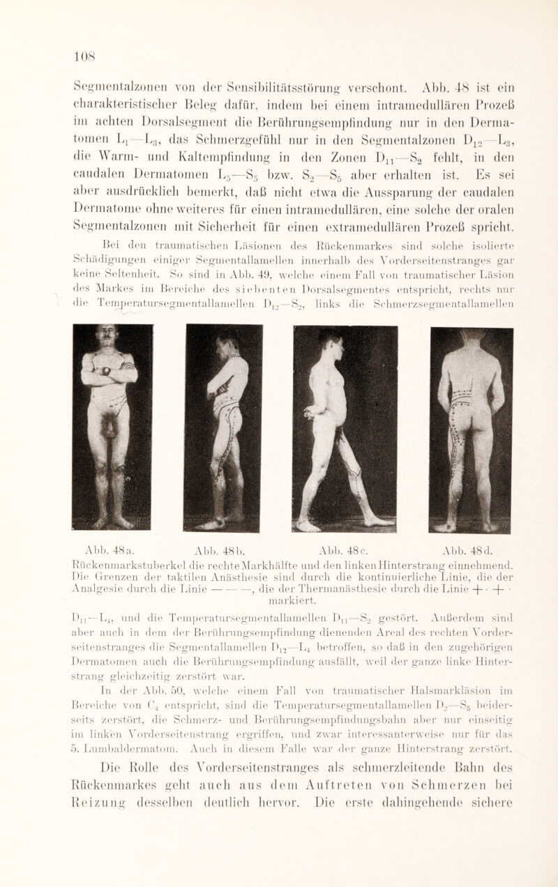 Segmentalzonen von der Sensibilitätsstörung verschont. Abb. 48 ist ein charakteristischer Beleg dafür, indem bei einem intramedullären Prozeß im achten Dorsalsegment die Berührungsempfindung nur in den Derma- tomen 1^—L3, das Sclimerzgefühl nur in den Segmentalzonen D12 L3, die Warm- und Kaltempfindung in den Zonen Dn—S2 fehlt, in den caudalen Dermatomen L5—S5 bzw. S2—S5 aber erhalten ist. Es sei aber ausdrücklich bemerkt, daß nicht etwa die Aussparung der caudalen Dermatome ohne weiteres für einen intramedullären, eine solche der oralen Segmentalzonen mit Sicherheit für einen extramedullären Prozeß spricht. Bei den traumatischen Läsionen des Rückenmarkes sind solche isolierte Schädigungen einiger Segmentallamelien innerhalb des Yorderseitenstranges gai* keine Seltenheit. So sind in Abb. 49, welche einem Fall von traumatischer Läsion des Markes im Bereiche des siebenten Dorsalsegmentes entspricht, rechts nur die Temperatursegmentallamelien D12—S2, links die Schmerzsegmentallamellen Abb. 48a. Abb. 48 b. Abb. 48 c. Abb. 48 d. Rückenmarkstuberkel die rechte Markhälfte und den linken Hinterstrang einnehmend. Die Grenzen der taktilen Anästhesie sind durch die kontinuierliche Linie, die der Analgesie durch die Linie-, die der Thermanästhesie durch die Linie -)-• + • markiert. Dn — L4, und die Temperatursegmentallamellen Dn—S2 gestört. Außerdem sind aber auch in dem der Berührungsempfindung dienenden Areal des rechten Yorder¬ seitenstranges die Segmentallamellen Dn—Ld betroffen, so daß in den zugehörigen Dermatomen auch die Berührungsempfindung ausfällt, weil der ganze linke Hinter¬ strang gleichzeitig zerstört war. In der Abb. 50, welche einem Fall von traumatischer Halsmarkläsion im Bereiche von C4 entspricht, sind die Temperatursegmentallamellen 4L—S5 beider¬ seits zerstört, die Schmerz- und Berührungsempfindungsbahn aber nur einseitig im linken Yorderseitenstrang ergriffen, und zwar interessanterweise nur für das 5. Lumbaldermatom. Auch in diesem Falle war der ganze Hinterstrang zerstört. Die Rolle des Yorderseitenstranges als schm erzleitende Bahn des Rückenmarkes geht auch aus dem Auftreten von Schmerzen bei Reizung desselben deutlich hervor. Die erste dahingehende sichere