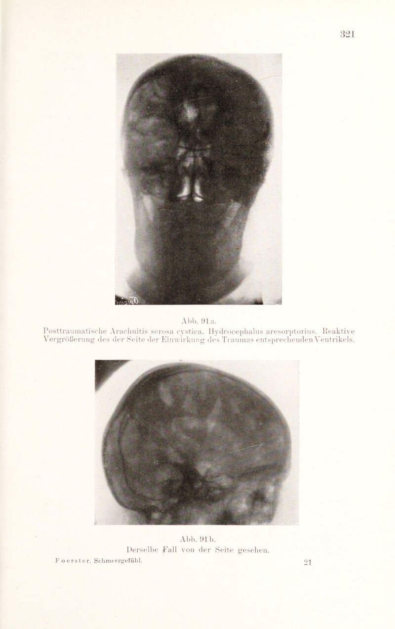 Abb. 91 a. Posttraumatische Arachnitis serosa cystica. Hydrocephalus aresorptorius. Reaktive Vergrößerung des der Seite der Einwirkung des Traumas entsprechenden Ventrikels. Abb. 91b. Derselbe Fall von der Seite gesehen. 21 Foers t er, Schmerzgefühl