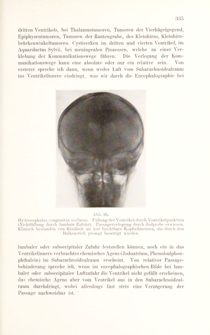 dritten Ventrikels, bei Thalamustumoren, Tumoren der Vierhügelgegend, Epiphysentumoren, Tumoren der Rautengrube, des Kleinhirns, Kleinhirn¬ brückenwinkeltumoren, Cysticerken im dritten und vierten Ventrikel, im Aquaeductus Sylvii, bei meningealen Prozessen, welche zu einer Ver¬ klebung der Kommunikationswege führen. Die Verlegung der Kom¬ munikationswege kann eine absolute oder nur ein relative sein. Von ersterer spreche ich dann, wenn weder Luft vom Subarachnoidealraum ins Ventrikelinnere eindringt, was wir durch die Encephalographie bei Abb. (J5. Hydrocephalus congenitus occlusus. Füllung der Ventrikel durch Ventrikelpunktion (Nichtfüllung durch lumbale Zufuhr). Passageverlegung durch Jodprobe erwiesen. Klinisch bestanden von Kindheit an nur furchtbare Kopfschmerzen, die durch den Balkenstich prompt beseitigt wurden. lumbaler oder suboccipitaler Zufuhr feststellen können, noch ein in das Ventrikelinnere verbrachtes chemisches Agens (Jodnatrium, Phenolsulphon¬ phthalein) im Subarachnoidealraum erscheint. Von relativer Passage¬ behinderung spreche ich, wenn im encephalographischen Bilde bei lum¬ baler oder suboccipitaler Luftzufuhr die Ventrikel nicht gefüllt erscheinen, das chemische Agens aber vom Ventrikel aus in den Subarachnoideal¬ raum durchdringt, wobei allerdings fast stets eine Verzögerung der Passage nachweisbar ist.