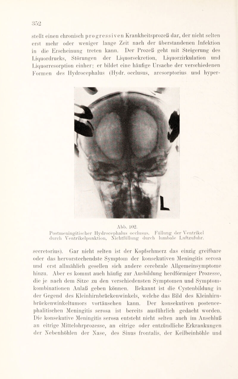 stellt einen chronisch progressiven Krankheitsprozeß dar, der nicht selten erst mehr oder weniger lange Zeit nach der überstandenen Infektion in die Erscheinung treten kann. Der Prozeß geht mit Steigerung des Liquordrucks, Störungen der Liquorsekretion, Liquorzirkulation und Liquorresorption einher: er bildet eine häufige Ursache der verschiedenen Formen des Hydrocephalus (Hydr. occlusus, aresorptorius und hyper- Abb. 102. Postmeningitischer Hydrocephalus occlusus. Füllung der Ventrikel durch Ventrikelpunktion, Nichtfüllung durch lumbale Luftzufuhr. secretorius). Gar nicht selten ist der Kopfschmerz das einzig greifbare oder das hervorstechendste Symptom der konsekutiven Meningitis serosa und erst allmählich gesellen sich andere cerebrale Allgemeinsymptome hinzu. Aber es kommt auch häufig zur Ausbildung herdförmiger Prozesse, die je nach dem Sitze zu den verschiedensten Symptomen und Symptom¬ kombinationen Anlaß geben können. Bekannt ist die Cystenbildung in der Gegend des Kleinhirnbrückenwinkels, welche das Bild des Kleinhirn¬ brückenwinkeltumors Vortäuschen kann. Der konsekutiven postence- phalitischen Meningitis serosa ist bereits ausführlich gedacht worden. Die konsekutive Meningitis serosa entsteht nicht selten auch im Anschluß an eitrige Mittelohrprozesse, an eitrige oder entzündliche Erkrankungen der Nebenhöhlen der Nase, des Sinus frontalis, der Keilbeinhöhle und