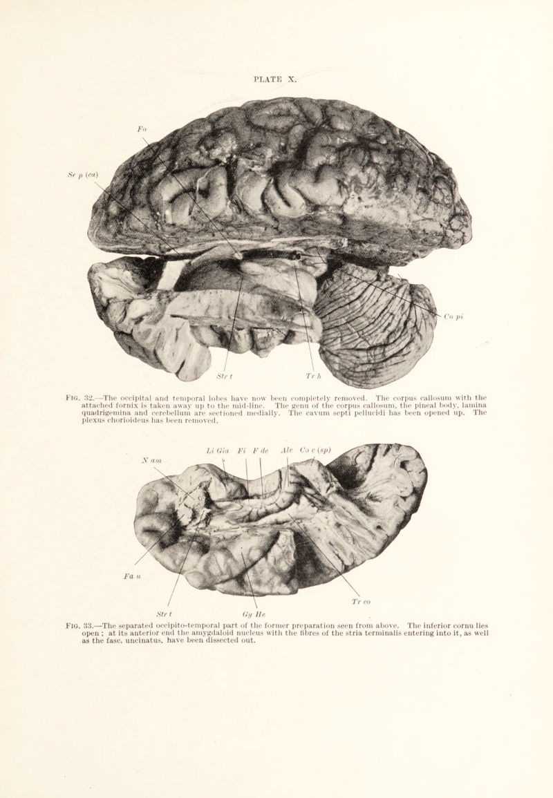 Fig. 32.—The occipital and temporal lobes have now been completely removed. The corpus callosum with the attached fornix is taken away up to the mid-line. The genu of the corpus callosum, the pineal body, lamina quadrigemina and cerebellum are sectioned medially. The cavum septi pellucidi has been opened up. The plexus chorioideus has been removed. Fa Str 1 Gy He Fig. 33.—The separated occipito-temporal part of the former preparation seen from above. The inferior cornu lies open ; at its anterior end the amygdaloid nucleus with the fibres of the stria terminalis entering into it, as well as the fasc. uncinatus. have been dissected out.