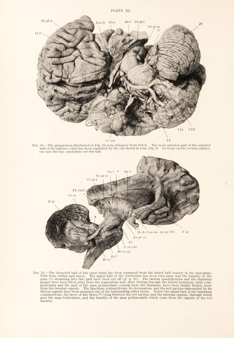 Co ma VI Fig. 34.—The preparation illustrated in Fig. 32 seen obliquely from below. The most anterior part of the superior wall of the inferior cornu has been separated by the cut shown in text, Fig. D. In front, on the section surface, one sees the fasc. uncinatus cut through. Fig. 35.—The dissected half of the same brain has been separated from the intact half exactly in the mid-plane. View from within and above. The upper half of the cerebellum has been torn away and the bundles of the pons (t) streaming into this part have been cut off (cf. p. 21). The lamina quadrigemina and the thalamus proper have been lifted away from the tegmentum and, after cutting through the lateral lemniscus, both corp. geniculata and the part of the ansa peduncularis coming from the thalamus, have been simply broken loose from the internal capsule. The brachium conjunctivum, its decussation, and the red nucleus surrounded by its fibrous capsule have been prepared out of the surrounding softer tissue. Notice the spiral turn of the brachium conjunctivum, the layer of fine fibres (*) lying between the red nucleus and the internal capsule, through which goes the ansa lenticularis, and the bundles of the ansa peduncularis which come from the capsule of the red nucleus.