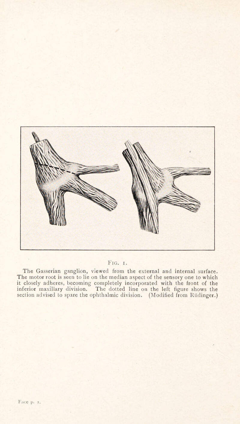 The Gasserian ganglion, viewed from the external and internal surface. The motor root is seen to lie on the median aspect of the sensory one to which it closely adheres, becoming completely incorporated with the front of the inferior maxillary division. The dotted line on the left figure shows the section advised to spare the ophthalmic division. (Modified from Riidinger.)