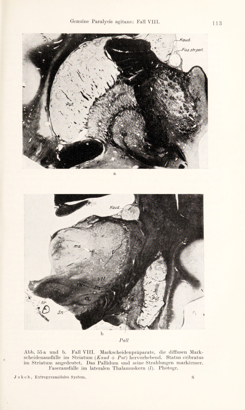 b Pall Abb. 55 a und b. Fall VIII. Markscheidenpräparate, die diffusen Mark¬ scheidenausfälle im Striatum (Kaud + Put) hervorhebend. Status cribratus im Striatum angedeutet. Das Pallidum und seine Strahlungen markärmer. Faserausfälle im lateralen Thalamuskern (l). Pliotogr. J akob, Extrapyramidales System 8