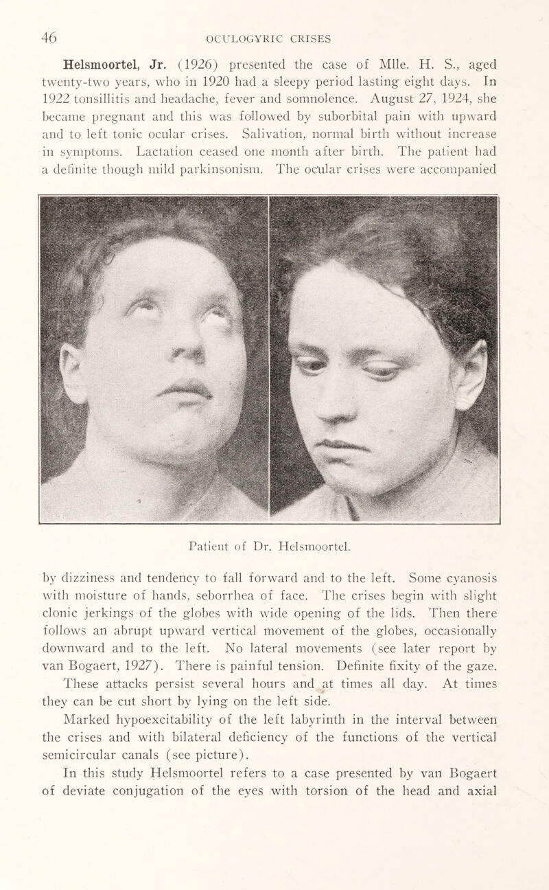 Helsmoortel, Jr. (1926) presented the case of Mile. H. S., aged twenty-two years, who in 1920 had a sleepy period lasting eight days. In 1922 tonsillitis and headache, fever and somnolence. August 27, 1924, she became pregnant and this was followed by suborbital pain with upward and to left tonic ocular crises. Salivation, normal birth without increase in symptoms. Lactation ceased one month after birth. The patient had a definite though mild parkinsonism. The ocular crises were accompanied Patient of Dr. Helsmoortel. by dizziness and tendency to fall forward and to the left. Some cyanosis with moisture of hands, seborrhea of face. The crises begin with slight clonic jerkings of the globes with wide opening of the lids. Then there follows an abrupt upward vertical movement of the globes, occasionally downward and to the left. No lateral movements (see later report by van Bogaert, 1927). There is painful tension. Definite fixity of the gaze. These attacks persist several hours and at times all day. At times they can be cut short by lying on the left side. Marked hypoexcitability of the left labyrinth in the interval between the crises and with bilateral deficiency of the functions of the vertical semicircular canals (see picture). In this study Helsmoortel refers to a case presented by van Bogaert of deviate conjugation of the eyes with torsion of the head and axial