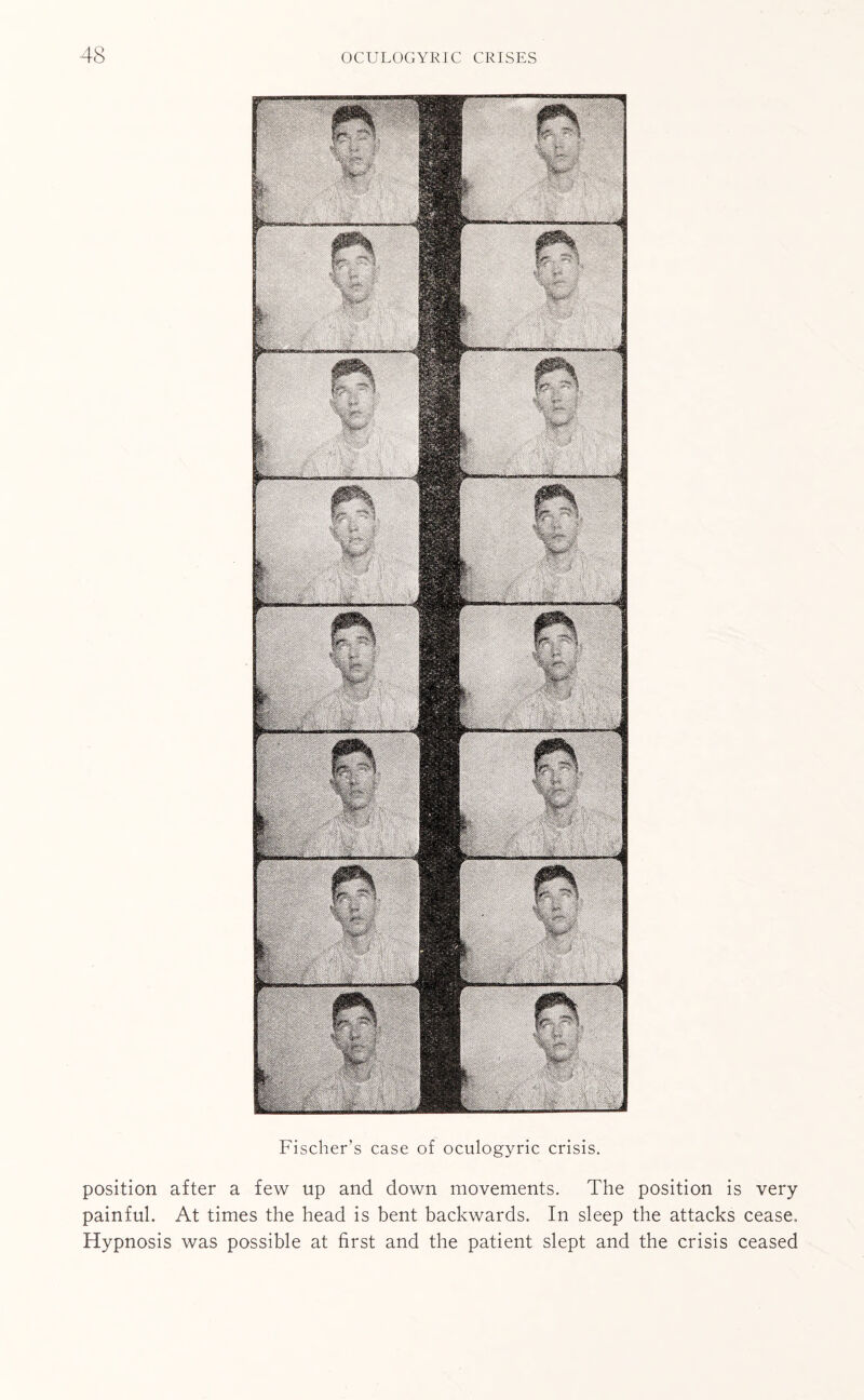 Fischer’s case of oculogyric crisis. position after a few up and down movements. The position is very painful. At times the head is bent backwards. In sleep the attacks cease. Hypnosis was possible at first and the patient slept and the crisis ceased