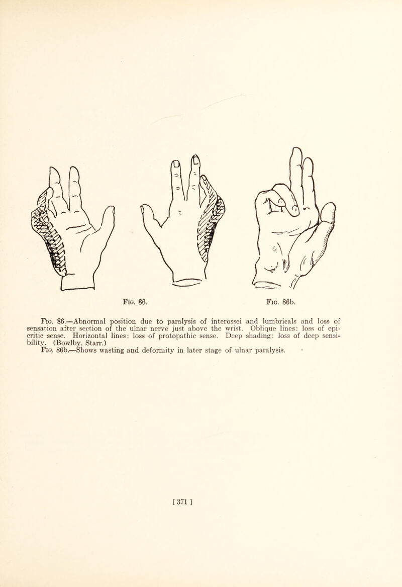 Fig. 86b. Fig. 86.—Abnormal position due to paralysis of interossei and lumbricals and loss of sensation after section of the ulnar nerve just above the wrist. Oblique lines: loss of epi- critic sense. Horizontal lines: loss of protopathic sense. Deep shading: loss of deep sensi¬ bility. (Bowlby, Starr.) Fig. 86b.—Shows wasting and deformity in later stage of ulnar paralysis. [371 ]