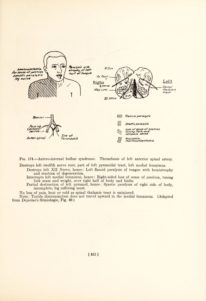 M Cun /,e*»’*naesft,es/a. far fenf* ofpOSitiort Spaffr* paraLyf/s /eg worse ^Jrra/ystS m/r'ttt atrophy of left h*/f of fongue Bight Xferre fled Lem. Left \Sp/ntx/ t/>a,/amiC trace- Xu A/erve r== F/acc/P para/ySis III Spastic pana/yS/'s Loss of sense ofposit/ on tuning for/c an 4 compass sense Ana/qesia, thermoa n cesthes/a Fig. 174.—Antero-internal bulbar syndrome. Thrombosis of left anterior spinal artery. Destroys left twelfth nerve root, part of left pyramidal tract, left medial lemniscus. Destroys left XII Nerve, hence: Left flaccid paralysis of tongue with hemiatrophy and reaction of degeneration. Interrupts left medial lemniscus, hence: Right-sided loss of sense of position, tuning fork sense and weight, over right half of body and limbs. Partial destruction of left pyramid, hence: Spastic paralysis of right side of body, incomplete, leg suffering most. No loss of pain, heat or cold as spinal thalamic tract is uninjured. Note: Tactile discrimination does not travel upward in the medial lemniscus. (Adapted from Dejerine’s Semiologie, Fig. 49.) [411]