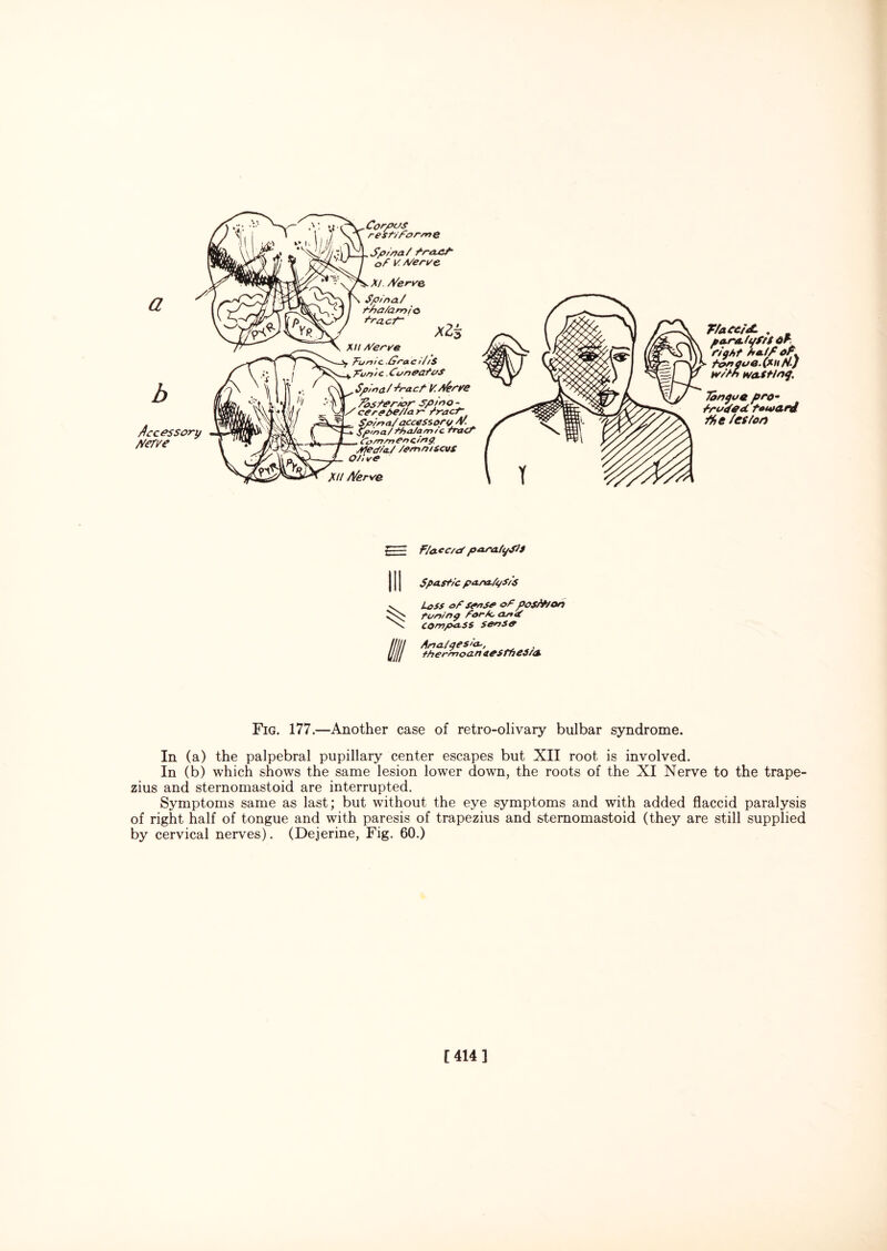 a Accessory tfer/e Corpos rest/forsnQ Spina/ traC-P of V. A/e rice XI. A/erre Spina./ tna/amio *acr~ a2£ XU Mer re pun I c Sraci /'/$ Punic. Cun&ataS Spina / /racf F. x/erre . Thsferiarspino- ceret>e//ar' tract- Spina/accessory A/. Spina/rha/a/n/c tnaCt . Cb/rrsnCncing. Alep/a./ /emmsevs O/ive XU A/erve med<L . . para(yf,fot ftgft half or. fonao&.{Xu H-J w//n wasting. Tongue pro - fru<fe<C foto&rd /%e /es/on F/acc/P p aj~a.fyS/S Spastic para/i/S/S Lass aPsrnsr of pos/hon tuning far/c cmS COmpaSS SenSO Fig. 177.—Another case of retro-olivary bulbar syndrome. In (a) the palpebral pupillary center escapes but XII root is involved. In (b) which shows the same lesion lower down, the roots of the XI Nerve to the trape¬ zius and sternomastoid are interrupted. Symptoms same as last; but without the eye symptoms and with added flaccid paralysis of right half of tongue and with paresis of trapezius and sternomastoid (they are still supplied by cervical nerves). (Dejerine, Fig. 60.) [414]