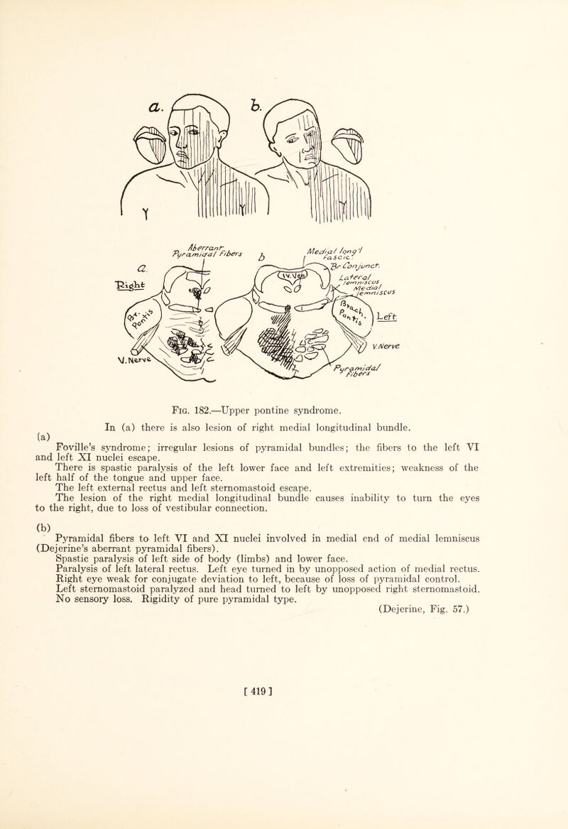 Fig. 182.—Upper pontine syndrome. In (a) there is also lesion of right medial longitudinal bundle. (a) Foville’s syndrome; irregular lesions of pyramidal bundles; the fibers to the left VI and left XI nuclei escape. There is spastic paralysis of the left lower face and left extremities; weakness of the left half of the tongue and upper face. The left external rectus and left sternomastoid escape. The lesion of the right medial longitudinal bundle causes inability to turn the eyes to the right, due to loss of vestibular connection. (b) Pyramidal fibers to left VI and XI nuclei involved in medial end of medial lemniscus (Dejerine’s aberrant pyramidal fibers). Spastic paralysis of left side of body (limbs) and lower face. Paralysis of left lateral rectus. Left eye turned in by unopposed action of medial rectus. Right eye weak for conjugate deviation to left, because of loss of pyramidal control. Left sternomastoid paralyzed and head turned to left by unopposed right sternomastoid. No sensory loss. Rigidity of pure pyramidal type. (Dejerine, Fig. 57.) [419]