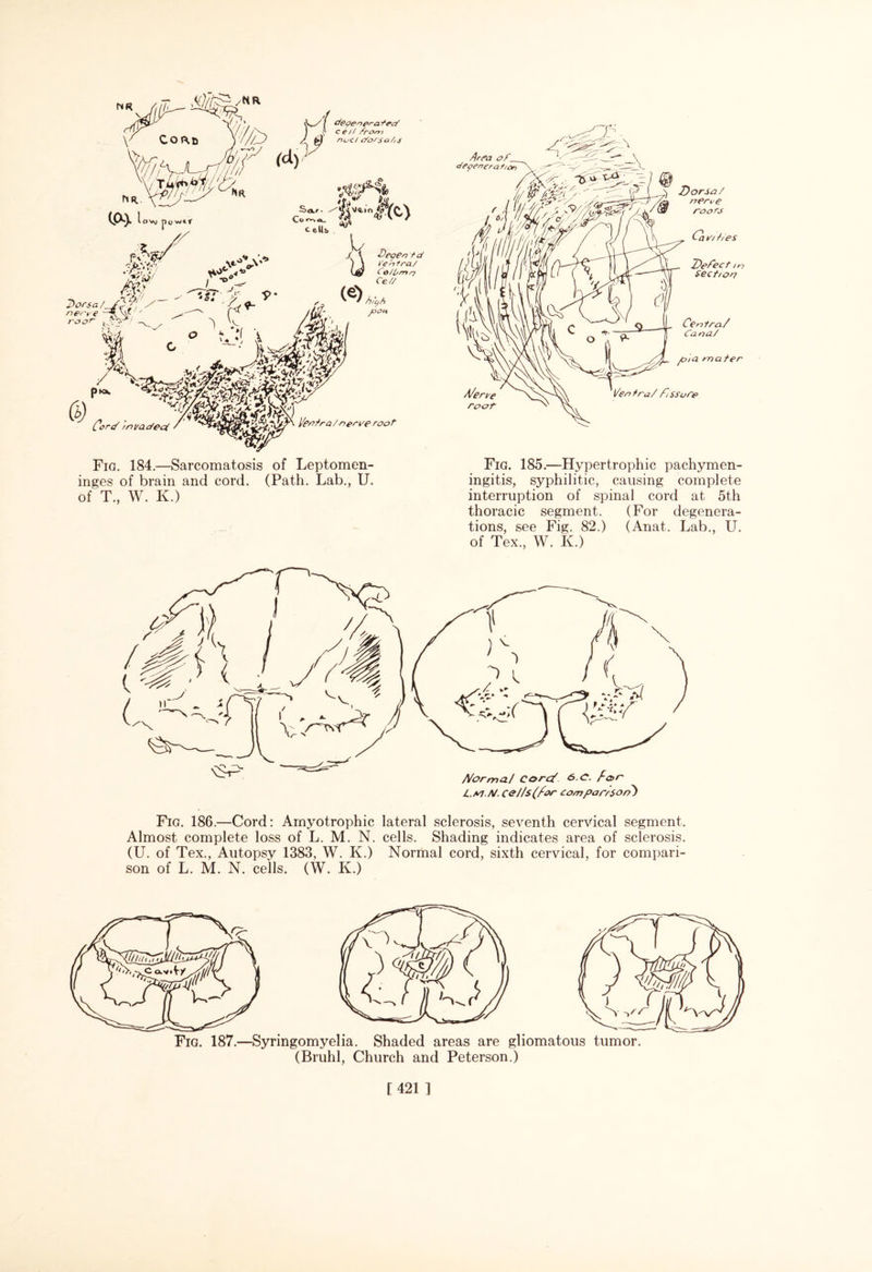 Fig. 184.—Sarcomatosis of Leptomen- inges of brain and cord. (Path. Lab., U. of T., W. K.) Fig. 185.—Hypertrophic pachymen¬ ingitis, syphilitic, causing complete interruption of spinal cord at 5th thoracic segment. (For degenera¬ tions, see Fig. 82.) (Anat. Lab., U. of Tex., W. K.) L.a'J.A/. CeJ/s(for com par/son') Fig. 186.—Cord: Amyotrophic lateral sclerosis, seventh cervical segment. Almost complete loss of L. M. N. cells. Shading indicates area of sclerosis. (U. of Tex., Autopsy 1383, W. K.) Normal cord, sixth cervical, for compari¬ son of L. M. N. cells. (W. K.) Fig. 187.—Syringomyelia. Shaded areas are gliomatous tumor. (Bruhl, Church and Peterson.) [421 ]