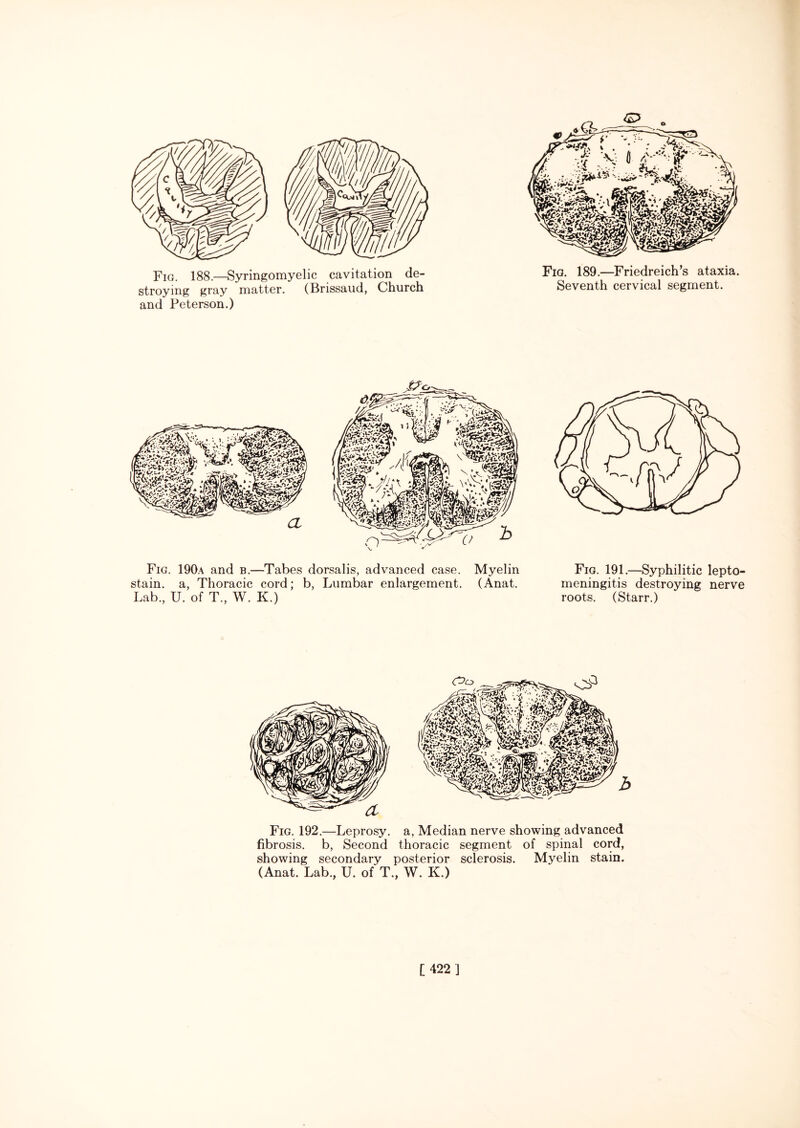 o Fig. 188.—Syringomyelic cavitation de¬ stroying gray matter. (Brissaud, Church and Peterson.) Fig. 189.—Friedreich’s ataxia. Seventh cervical segment. Fig. 190a and b.—Tabes dorsalis, advanced case, stain, a, Thoracic cord; b, Lumbar enlargement. Lab., U. of T., W. K.) Myelin (Anat. Fig. 191.—Syphilitic lepto¬ meningitis destroying nerve roots. (Starr.) a Fig. 192.—Leprosy, a, Median nerve showing advanced fibrosis, b, Second thoracic segment of spinal cord, showing secondary posterior sclerosis. Myelin stain. (Anat. Lab., U. of T., W. K.)