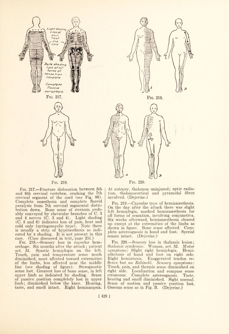 Fig. 217.—- Fracture dislocation between 5th and 6th cervical vertebrae, crushing the 7th cervical segment of the cord (see Fig. 98). Complete anaesthesia and complete flaccid paralysis from 7th cervical segmental distri¬ bution down. Bone sense of sternum prob¬ ably conveyed by clavicular branches of C. 3 and 4 nerves (C. 3 and 4). Light shading (C. 5 and 6) indicates loss of pain, heat and cold only (syringomyelic type). Note there is usually a strip of hyperaesthesia as indi¬ cated by x shading. It is not present in this case. (Case discussed in text, page 251.) Fig. 218.—Sensory loss in capsular hem¬ orrhage. Six months after the attack; patient aet. 51. Spastic hemiplegia on the left. Touch, pain and temperature sense much diminished, most affected toward extremities of the limbs, less affected near the middle line (see shading of figure). Sterognostic sense lost. Greatest loss of bone sense, in left upper limb as indicated by shading. Sense of passive position completely lost in upper limb; diminished below the knee. Hearing, taste, and smell intact. Right hemianopsia. Fig. 220. At autopsy, thalamus uninjured; optic radia¬ tion, thalamocortical and pyramidal fibers involved. (Dejerine.) Fig. 219.—Capsular type of hemiansesthesia. On the day after the attack there was slight left hemiplegia, marked hemiansesthesia for all forms of sensation, involving conjunctiva. Six weeks afterward, hemiansesthesia cleared up except at the extremities of the limbs as shown in figure. Bone sense affected. Com¬ plete astereognosis in hand and foot. Special senses intact. (Dejerine.) Fig. 220.—Sensory loss in thalamic lesion; thalamic syndrome. Woman, aet. 52. Motor symptoms: Slight right hemiplegia. Hemi- athetosis of hand and foot on right side. Right hemiataxia. Exaggerated tendon re¬ flexes but no Babinski. Sensory symptoms: Touch, pain, and thermic sense diminished on right side. Localization and compass sense erroneous. Complete astereognosis. Taste, hearing and smell diminished. Sight normal. Sense of motion and passive position lost. Osseous sense as in Fig. B. (Dejerine.)