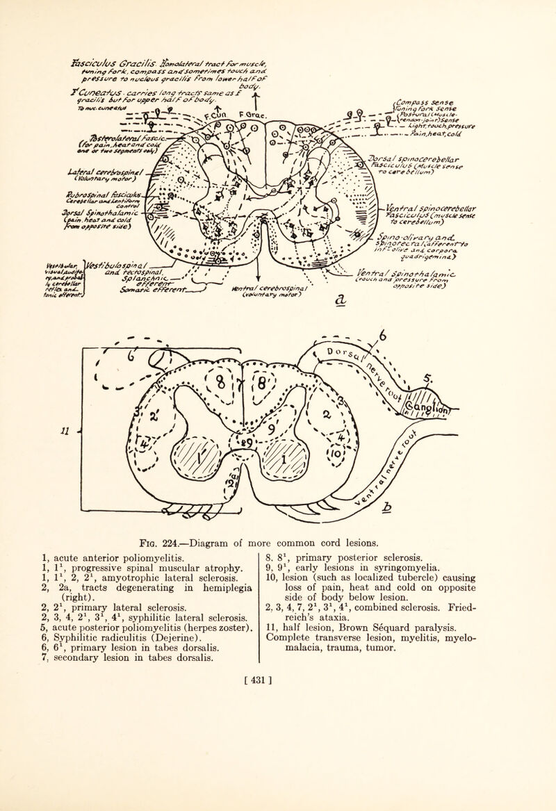 F Qra.c. IhfC/CoJuS £rac//is Jfomo/atera/ tract for musc/e, tuning fork. Compass a.nd'Somet/meS touch amd pressure to nuc/euS graci/Ss /'font /oseer ha/f of . . hocfg. T Ci/oea/os ■ earned /ong trac/S Same OS £ jl grac///s Sot for upper ha/fofbcx/y. 7i m/c- cuneetu* a in <♦» | r L.-sJt ~ ^ ^ f.cTn —-M*--- •••• —>• JL •• «» . Tbsfero/afem/fasc/c: (for pain,Seat and co/s One or two sep/neafJ oily) lateral cerebrospinal (Vb/vOtary motor) PobtOSp/'aa/ /vscicu/us. CcreAc liar and AentHb/nt Control 3or$a/ Spinothalamic (pa./rt. heat and co/d < opposite s/de) Vttt/Aofar, K?sl Solo spin a / alAudito ndpslal V/SOi ry,oj>Spr, /y cereieiUr ret/ex and. tonic efferent) /Compass sense a \fo/iing torn sense fljur. — - 'T /Pos-tora/(Aivsc/e- a U . — ~y-A+enaoo-jo'-nf)Sense — __*—. — /Light touch.pressure —i— rsx/p toL/r.heat co/d 7)orSa / spmocpreb e/la r fa.sc/c u/uS (efufc/e sense —\ ro cerebellum) and. tectospinal. t Splanchnic. —' ' efferenf Sontar/c efferent Hentra/cerebrospina / (roiontary motor) Venfra/ spinocerebellar Pa sc/co/uS (musc/e sense to cerebellum) Sp>/no -o/iya ry and. spi no tec ta /(after on t~to in f- O/iye and. corpora. go a. dr/gem in a.} fen/ra/Spmothalaoi/C. (touch ana pressure fro/n opposite side} cL Fig. 224.—Diagram of more common cord lesions. 1, acute anterior poliomyelitis. 1, l1, progressive spinal muscular atrophy. 1, l1, 2, 21, amyotrophic lateral sclerosis. 2, 2a, tracts degenerating in hemiplegia (right). 2, 21, primary lateral sclerosis. 2, 3, 4, 21, 31, 41, syphilitic lateral sclerosis. 5, acute posterior poliomyelitis (herpes zoster). 6, Syphilitic radiculitis (Dejerine). 6, 61, primary lesion in tabes dorsalis. 7. secondary lesion in tabes dorsalis. 8, 81 2 * * 5 6 7, primary posterior sclerosis. 9, 91, early lesions in syringomyelia. 10, lesion (such as localized tubercle) causing loss of pain, heat and cold on opposite side of body below lesion. 2, 3, 4, 7, 21, 31, 41, combined sclerosis. Fried¬ reich’s ataxia. 11, half lesion, Brown Sequard paralysis. Complete transverse lesion, myelitis, myelo¬ malacia, trauma, tumor. [431]