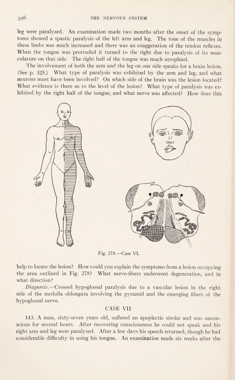 leg were paralyzed. An examination made two months after the onset of the symp¬ toms showed a spastic paralysis of the left arm and leg. The tone of the muscles in these limbs was much increased and there was an exaggeration of the tendon reflexes. When the tongue was protruded it turned to the right due to paralysis of its mus¬ culature on that side. The right half of the tongue was much atrophied. The involvement of both the arm and the leg on one side speaks for a brain lesion. (See p. 325.) What type of paralysis was exhibited by the arm and leg, and what neurons must have been involved? On which side of the brain was the lesion located? What evidence is there as to the level of the lesion? What type of paralysis was ex¬ hibited by the right half of the tongue, and what nerve was affected? How does this Fig. 278.—Case VI. help to locate the lesion? How could you explain the symptoms from a lesion occupying the area outlined in Fig. 278? What nerve-fibers underwent degeneration, and in what direction? . Diagnosis.—Crossed hypoglossal paralysis due to a vascular lesion in the right side of the medulla oblongata involving the pyramid and the emerging fibers of the hypoglossal nerve. CASE VII 143. A man, sixty-seven years old, suffered an apoplectic stroke and was uncon¬ scious for several hours. After recovering consciousness he could not speak and his right arm and leg were paralyzed. After a few davs his speech returned, though he had considerable difficulty in using his tongue. An examination made six weeks after the