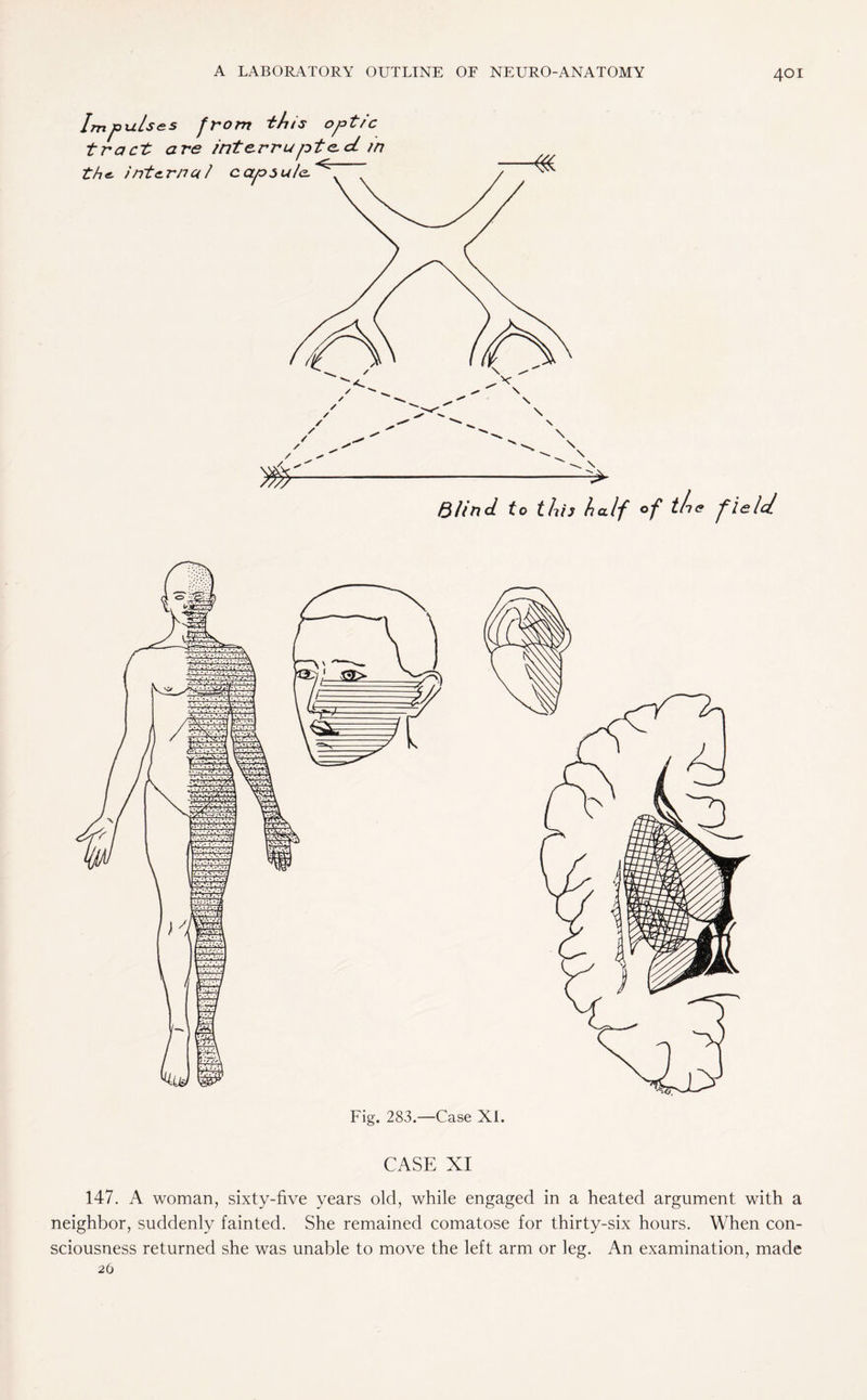 Blind to thh half of the f ield. CASE XI 147. A woman, sixty-five years old, while engaged in a heated argument with a neighbor, suddenly fainted. She remained comatose for thirty-six hours. When con¬ sciousness returned she was unable to move the left arm or leg. An examination, made 26
