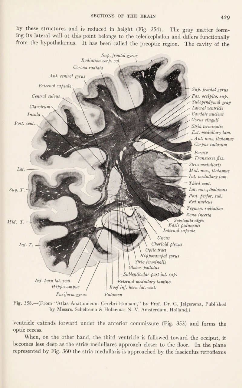 by these structures and is reduced in height (Fig. 354). The gray matter form¬ ing its lateral wall at this point belongs to the telencephalon and differs functionally from the hypothalamus. It has been called the preoptic region. The cavity of the Ant. central gyrus Sup. frontal gyrus Radiation corp. cal. Corona radiata External capsule Central sulcus Claustrum Insula Post. cent. Lat. Hid. T. Inf. horn lat. vent. Hippocampus Sup. frontal gyrus Fas. occipito. sup. Subependymal gray Lateral ventricle Caudate nucleus Gyrus cinguli Stria terminalis Ext. medullary lam. Ant. nuc., thalamus Corpus callosum Fornix Transverse fiss. Stria medullaris Med. nuc., thalamus Int. medullary lam. Third vent. Lat. nuc.y thalamus Post, perfor. sub. Red nucleus Tegmen. radiation Zona incerta Substantia nigra Basis pedunculi Internal cap side U nous Chorioid plexus Optic tract Hippocampal gyrus Stria terminalis Globus pallidus Sublenticular part int. cap. \ External medullary lamina Roof inf. horn lat. vent. Fusiform gyrus Putamen Fig. 358.—(From “Atlas Anatomicum Cerebri Humani,” by Prof. Dr. G. Jelgersma, Published by Messrs. Scheltema & Holkema; N. V. Amsterdam, Holland.) ventricle extends forward under the anterior commissure (Fig. 353) and forms the optic recess. When, on the other hand, the third ventricle is followed toward the occiput, it becomes less deep as the striae medullares approach closer to the floor. In the plane represented by Fig. 360 the stria medullaris is approached by the fasciculus retroflexus