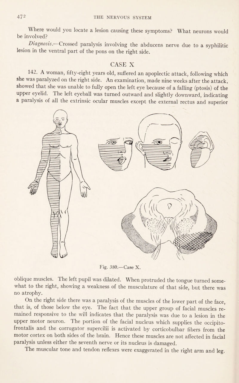 Where would you locate a lesion causing these symptoms? What neurons would be involved? Diagnosis. Crossed paralysis involving the abducens nerve due to a syphilitic lesion in the ventral part of the pons on the right side. CASE X 142. A woman, fifty-eight years old, suffered an apoplectic attack, following which she was paralyzed on the right side. An examination, made nine weeks after the attack, showed that she was unable to fully open the left eye because of a falling (ptosis) of the upper eyelid. The left eyeball was turned outward and slightly downward, indicating a paralysis of all the extrinsic ocular muscles except the external rectus and superior oblique muscles. The left pupil was dilated. When protruded the tongue turned some¬ what to the right, showing a weakness of the musculature of that side, but there was no atrophy. On the right side there was a paralysis of the muscles of the lower part of the face, that is, of those below the eye. The fact that the upper group of facial muscles re¬ mained responsive to the will indicates that the paralysis was due to a lesion in the upper motor neuron. The portion of the facial nucleus which supplies the occipito¬ frontalis and the corrugator supercilii is activated by corticobulbar fibers from the motor cortex on both sides of the brain. Hence these muscles are not affected in facial paralysis unless either the seventh nerve or its nucleus is damaged. The muscular tone and tendon reflexes were exaggerated in the right arm and leg.