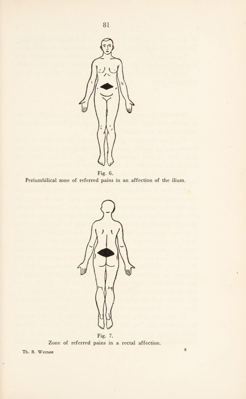 Fig. 6. Periumbilical zone of referred pains in an affection of the ilium. Fig. 7. Zone of referred pains in a rectal affection. Th. B. Wern0e