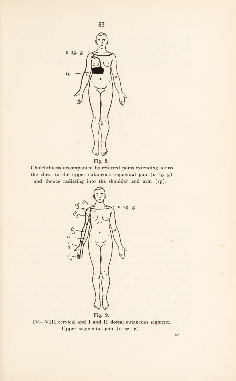 Cholelithiasis accompanied by referred pains extending across the chest to the upper cutaneous segmental gap (u sg. g) and thence radiating into the shoulder and arm (rp). IV—VIII cervical and I and II dorsal cutaneous segment. Upper segmental gap (u sg. g). 6*