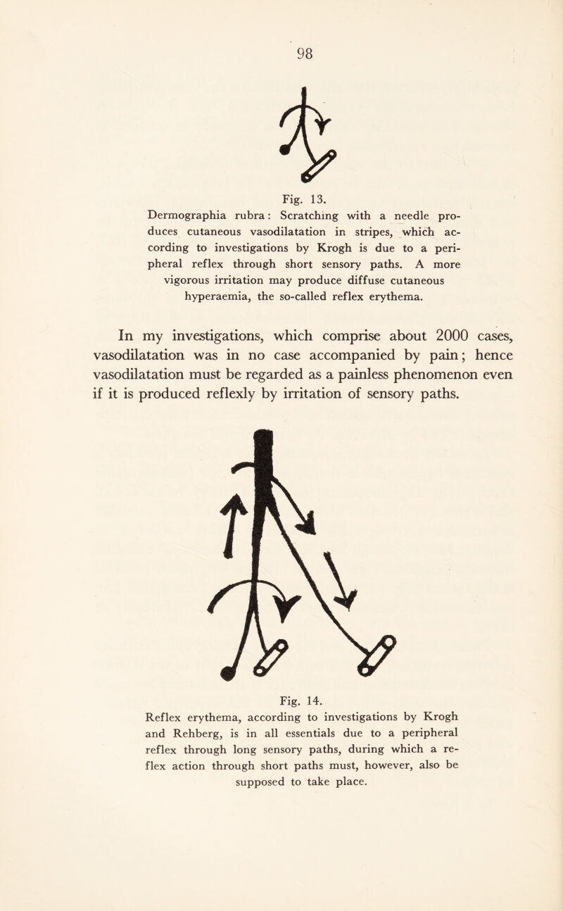 Fig. 13. Dermographia rubra: Scratching with a needle pro¬ duces cutaneous vasodilatation in stripes, which ac¬ cording to investigations by Krogh is due to a peri¬ pheral reflex through short sensory paths. A more vigorous irritation may produce diffuse cutaneous hyperaemia, the so-called reflex erythema. In my investigations, which comprise about 2000 cases, vasodilatation was in no case accompanied by pain; hence vasodilatation must be regarded as a painless phenomenon even if it is produced reflexly by irritation of sensory paths. Fig. 14. Reflex erythema, according to investigations by Krogh and Rehberg, is in all essentials due to a peripheral reflex through long sensory paths, during which a re¬ flex action through short paths must, however, also be supposed to take place.