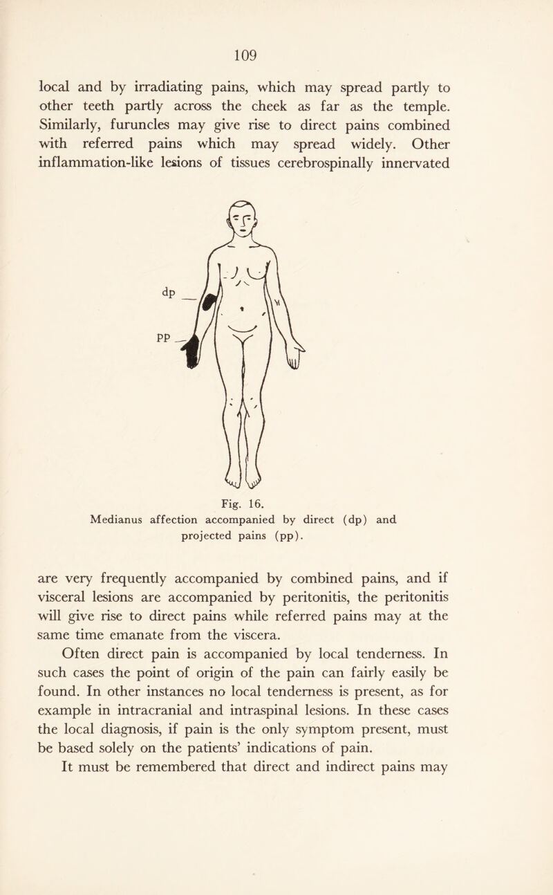 local and by irradiating pains, which may spread partly to other teeth partly across the cheek as far as the temple. Similarly, furuncles may give rise to direct pains combined with referred pains which may spread widely. Other inflammation-like lesions of tissues cerebrospinally innervated Fig. 16. Medianus affection accompanied by direct (dp) and projected pains (pp). are very frequently accompanied by combined pains, and if visceral lesions are accompanied by peritonitis, the peritonitis will give rise to direct pains while referred pains may at the same time emanate from the viscera. Often direct pain is accompanied by local tenderness. In such cases the point of origin of the pain can fairly easily be found. In other instances no local tenderness is present, as for example in intracranial and intraspinal lesions. In these cases the local diagnosis, if pain is the only symptom present, must be based solely on the patients’ indications of pain. It must be remembered that direct and indirect pains may